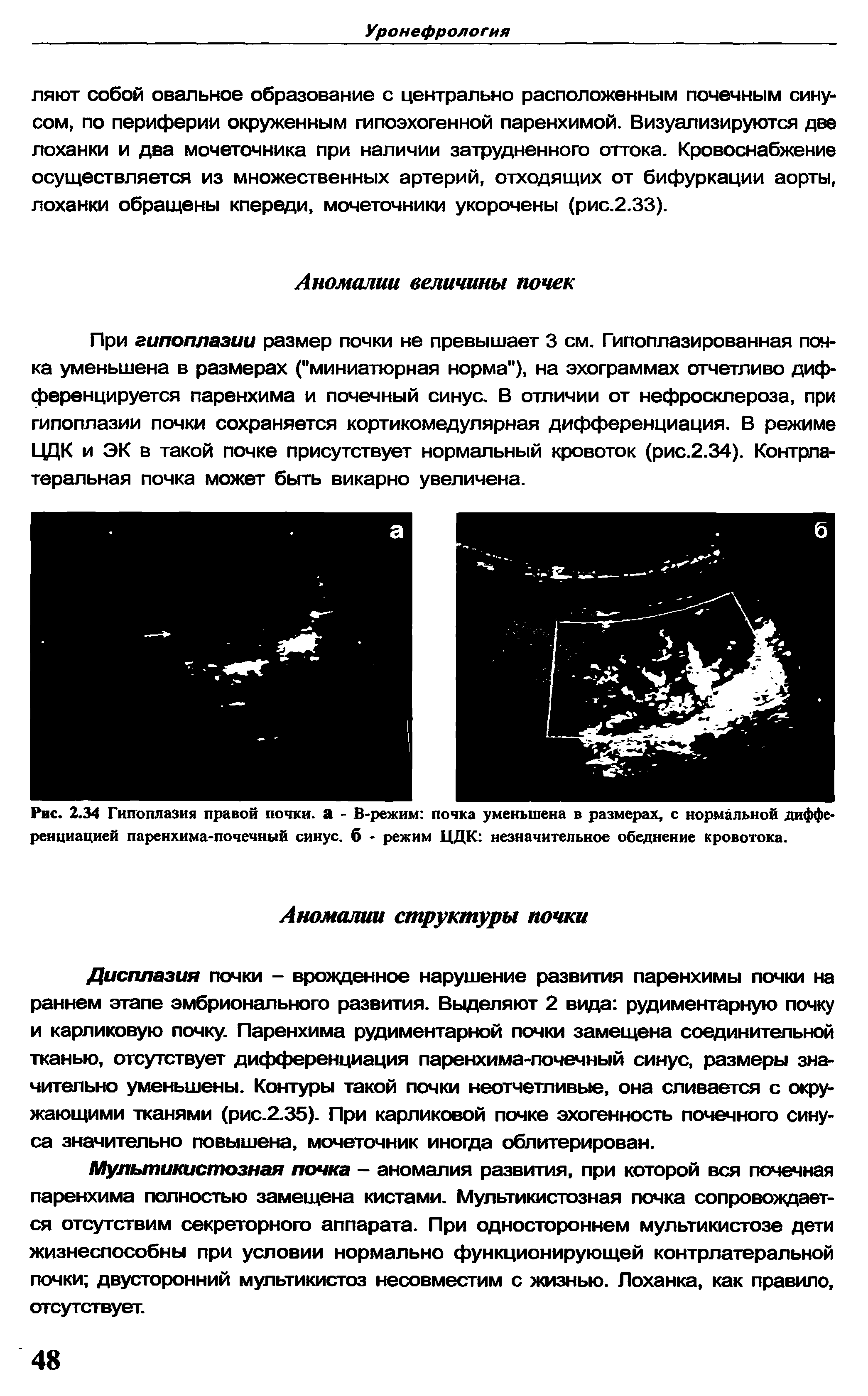 Рис. 2.34 Гипоплазия правой почки, а - В-режим почка уменьшена в размерах, с нормальной дифференциацией паренхима-почечный синус, б - режим ЦДК незначительное обеднение кровотока.