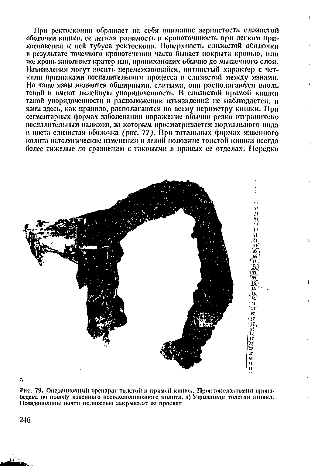 Рис. 79. Операционный препарат толстой и примой кишок. Проктоколэктомия произведена по поводу язвенного псевдиполппозпого колита, а) Удаленная толстая кишка. Псевдополипы почти полностью закрывают се просвет...