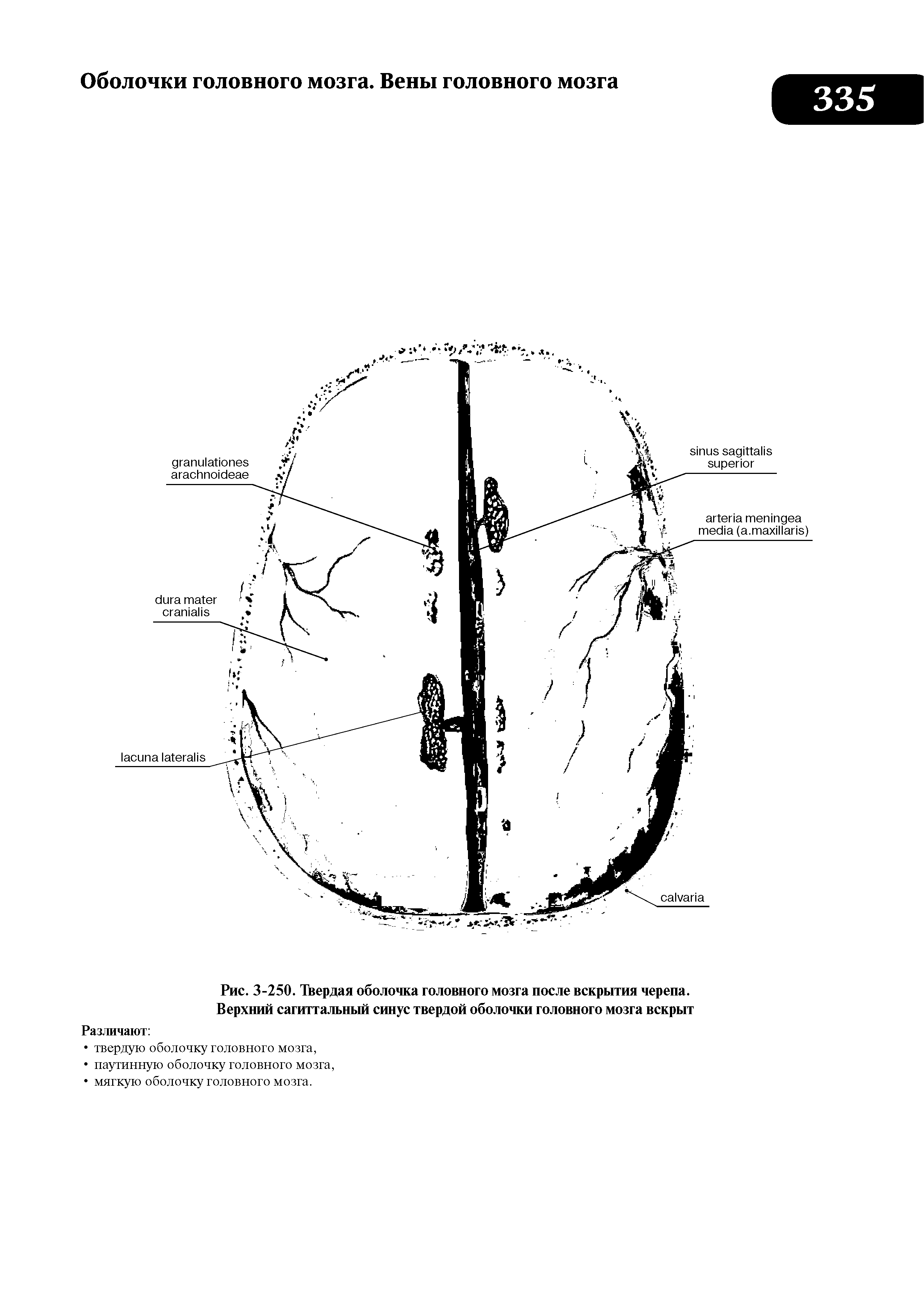 Рис. 3-250. Твердая оболочка головного мозга после вскрытия черепа. Верхний сагиттальный синус твердой оболочки головного мозга вскрыт...