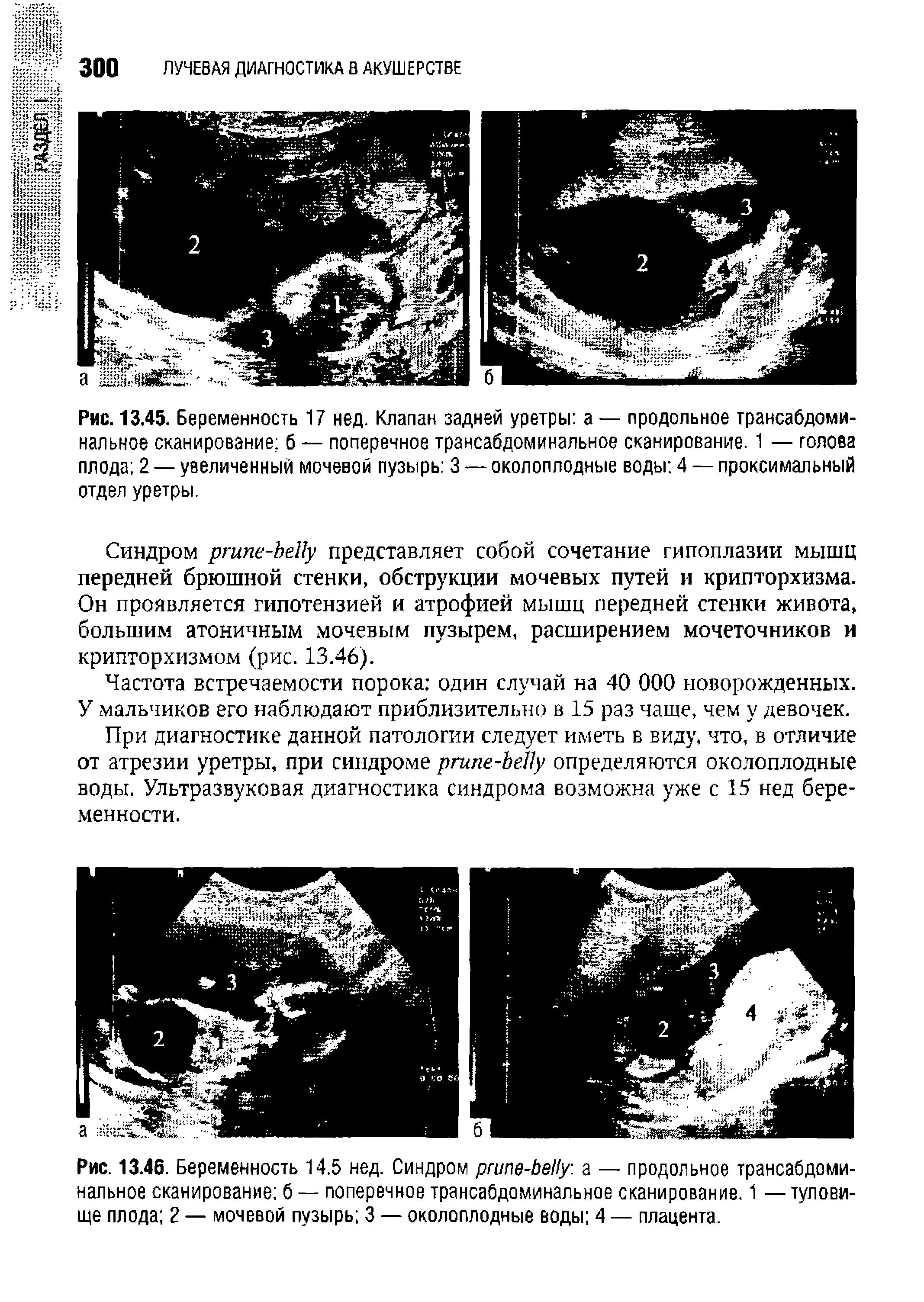 Рис. 13.45. Беременность 17 нед. Клапан задней уретры а — продольное трансабдоминальное сканирование б — поперечное трансабдоминальное сканирование. 1 — голова плода 2 — увеличенный мочевой пузырь 3 — околоплодные воды 4 — проксимальный отдел уретры.