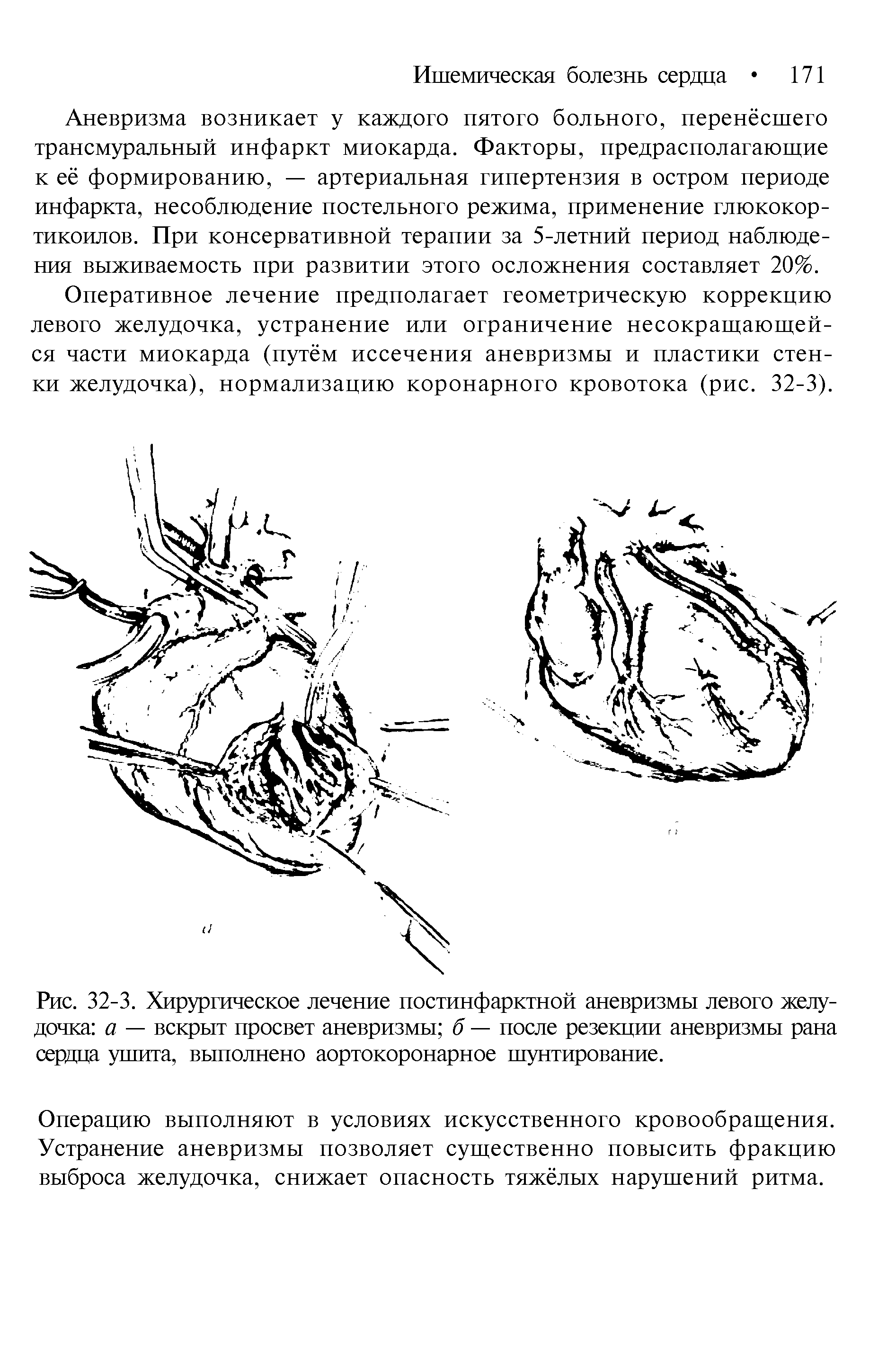 Рис. 32-3. Хирургическое лечение постинфарктной аневризмы левого желудочка а — вскрыт просвет аневризмы б — после резекции аневризмы рана сердца ушита, выполнено аортокоронарное шунтирование.