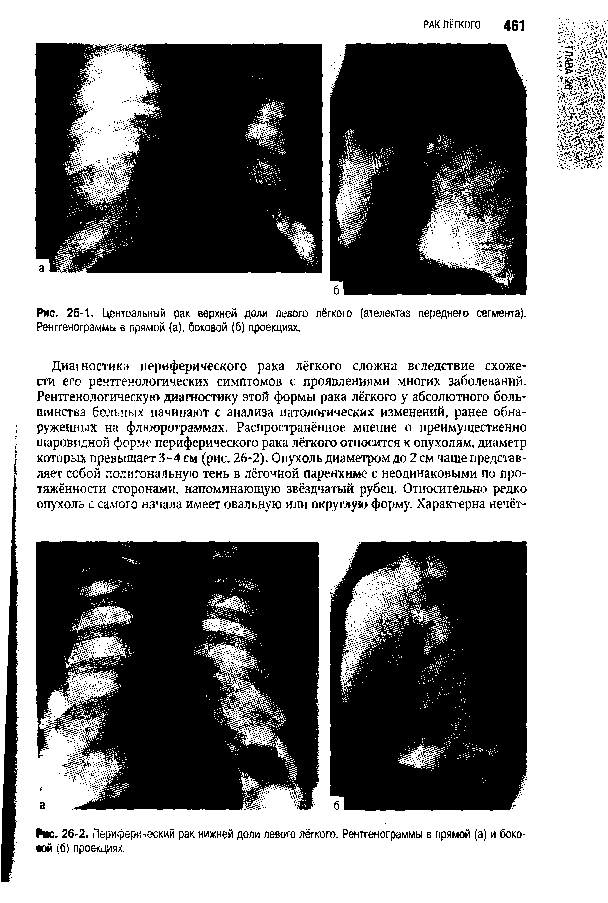 Рис. 26-2. Периферический рак нижней доли левого лёгкого. Рентгенограммы в прямой (а) и боковой (б) проекциях.