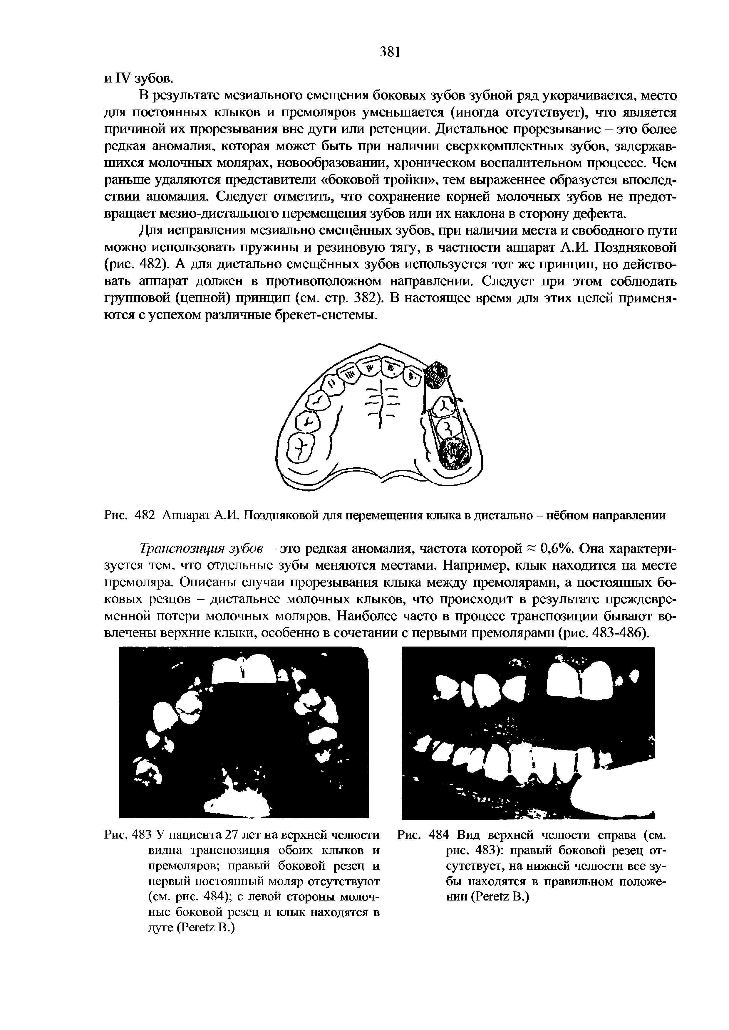 Рис. 483 У пациента 27 лет на верхней челюсти видна транспозиция обоих клыков и премоляров правый боковой резец и первый постоянный моляр отсутствуют (см. рис. 484) с левой стороны молочные боковой резец и клык находятся в дуге (Роге / В.)...