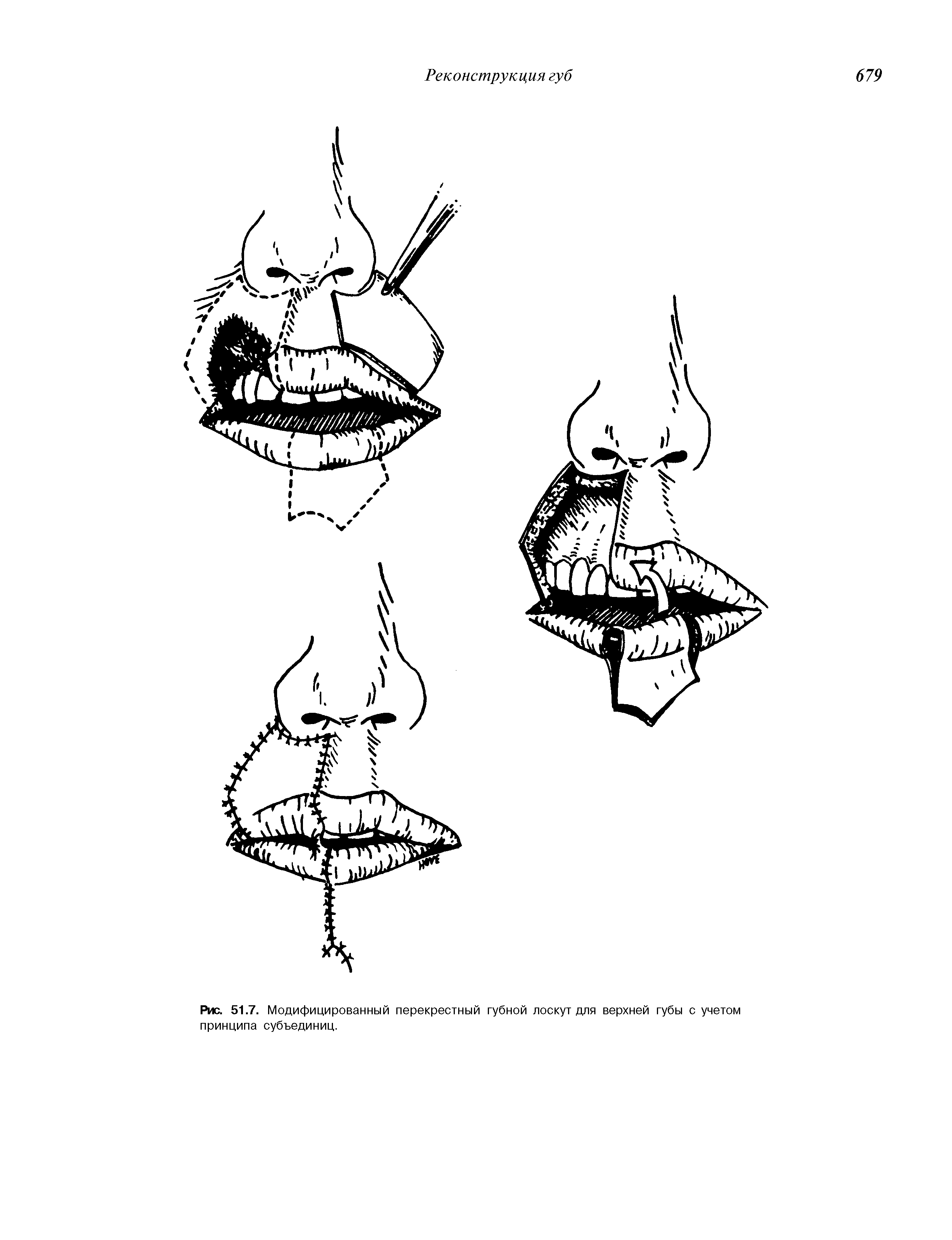 Рис. 51.7. Модифицированный перекрестный губной лоскут для верхней губы с учетом принципа субъединиц.