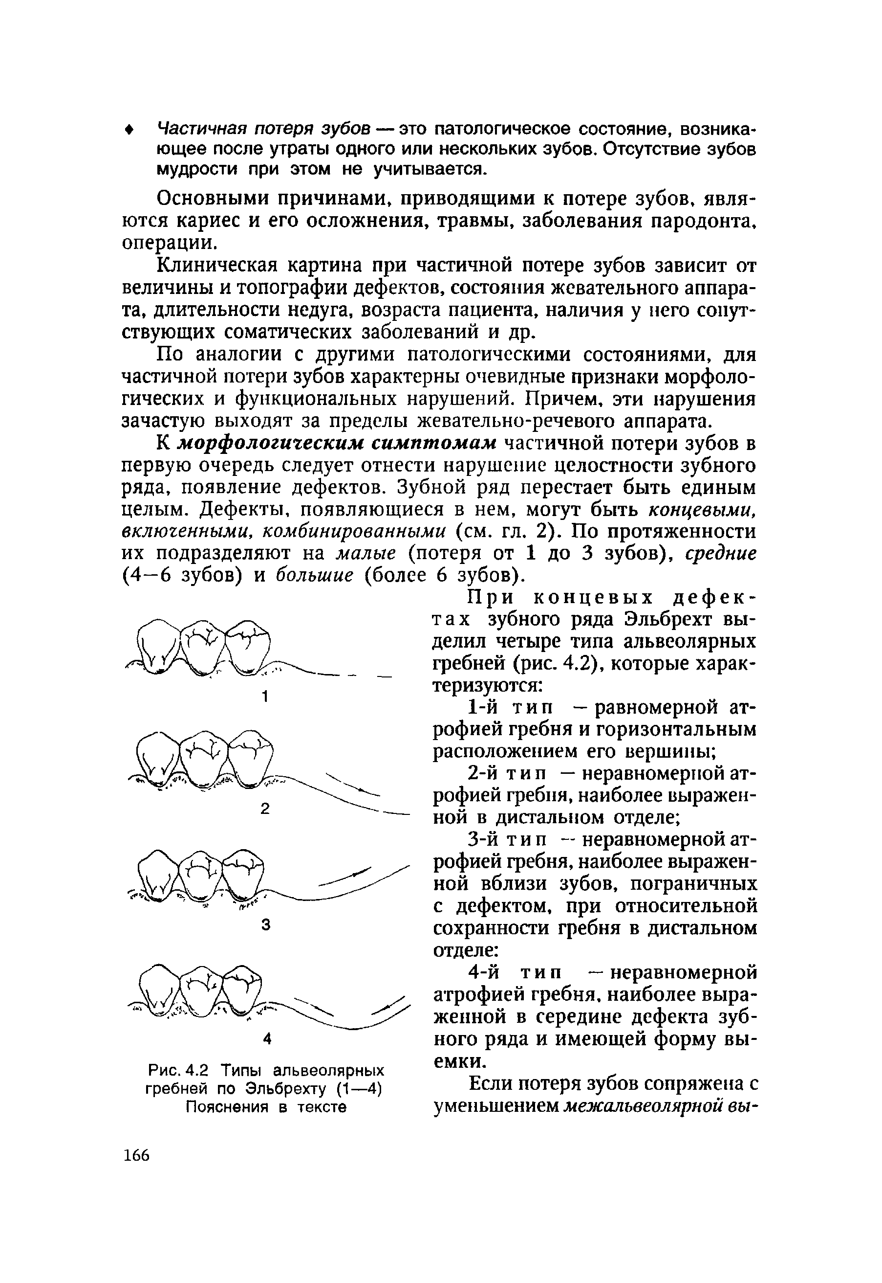 Рис.4.2 Типы альвеолярных гребней по Эльбрехту (1—4) Пояснения в тексте...