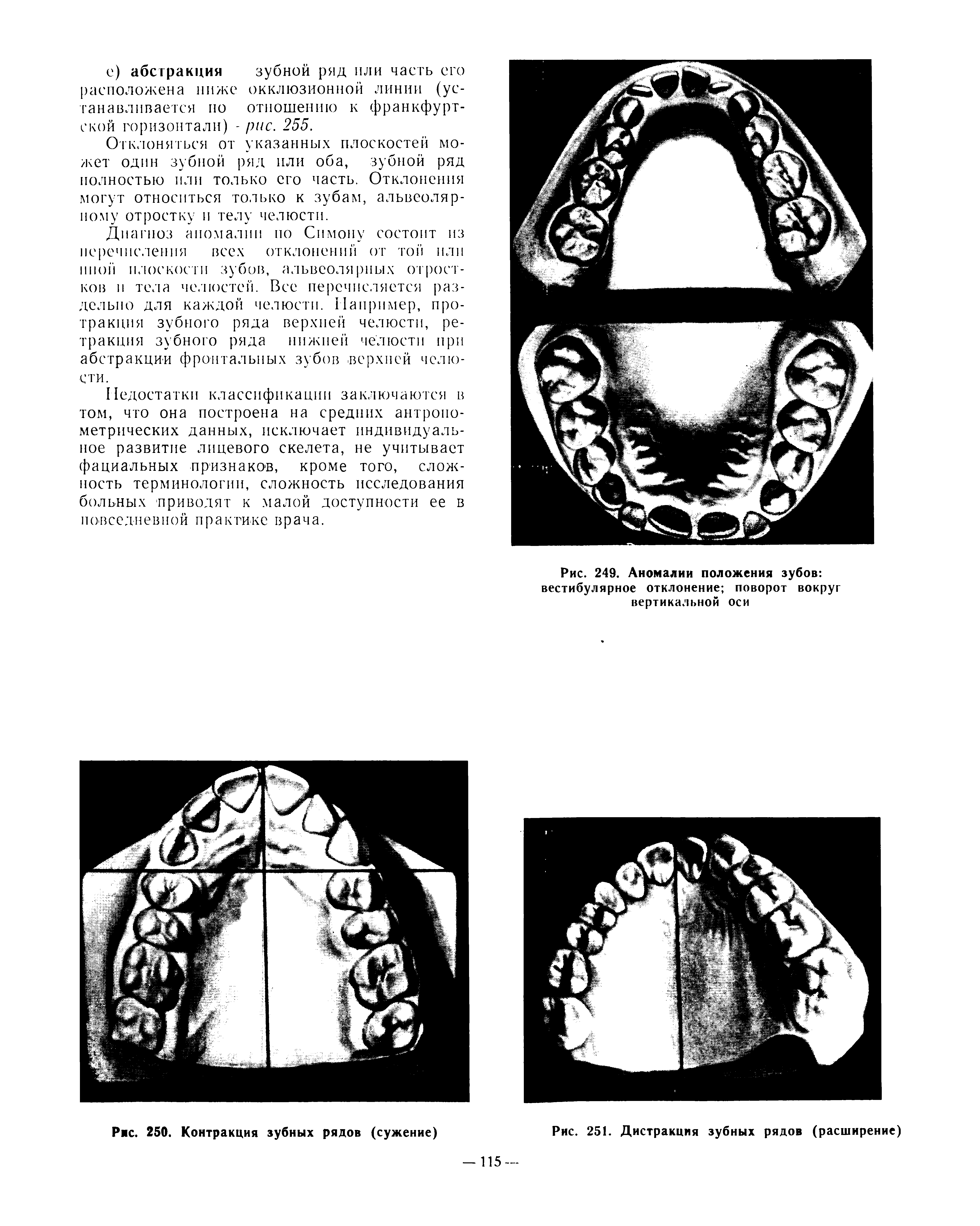 Рис. 249. Аномалии положения зубов вестибулярное отклонение поворот вокруг вертикальной оси...