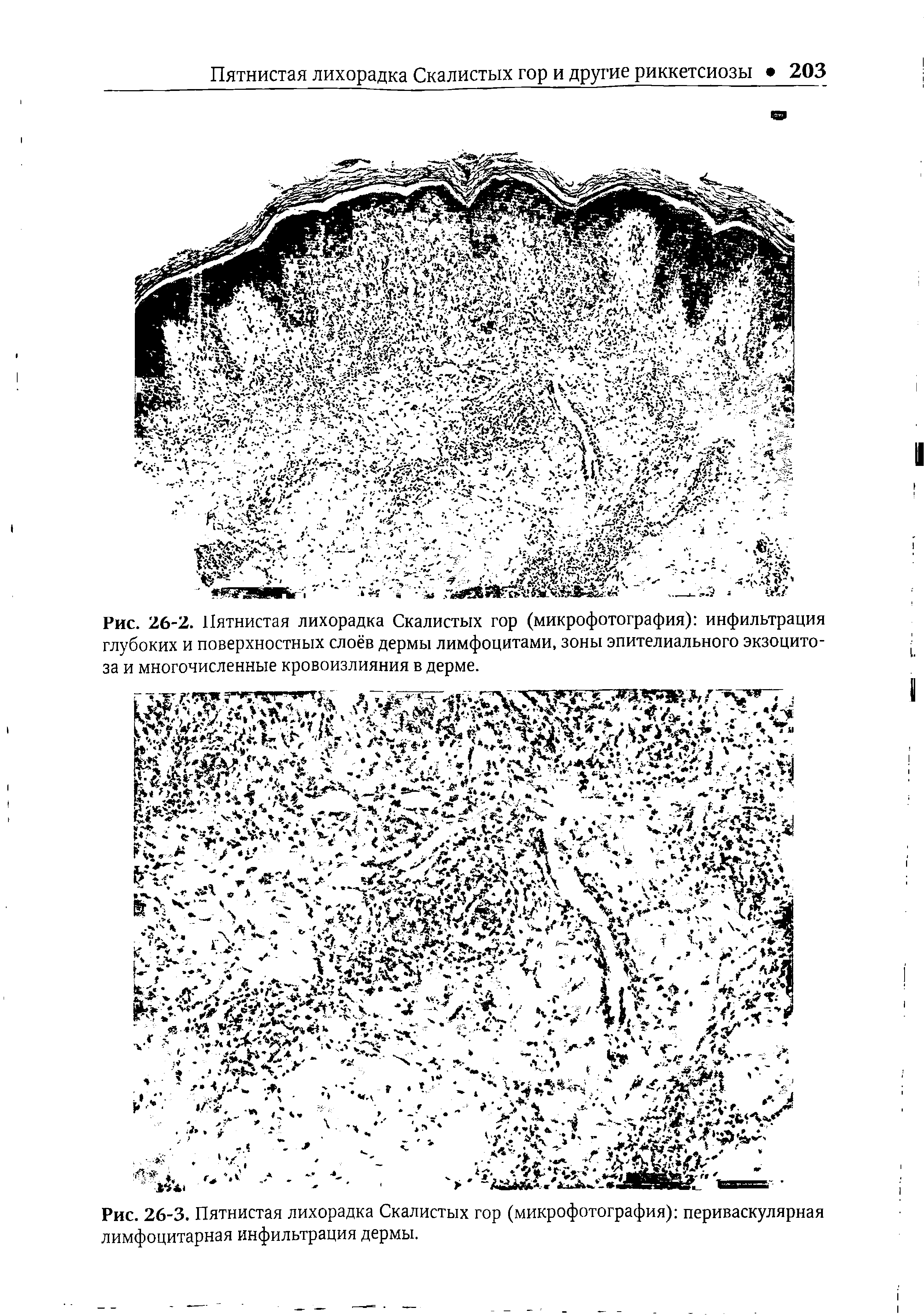 Рис. 26-2. Пятнистая лихорадка Скалистых гор (микрофотография) инфильтрация глубоких и поверхностных слоёв дермы лимфоцитами, зоны эпителиального экзоцито-...