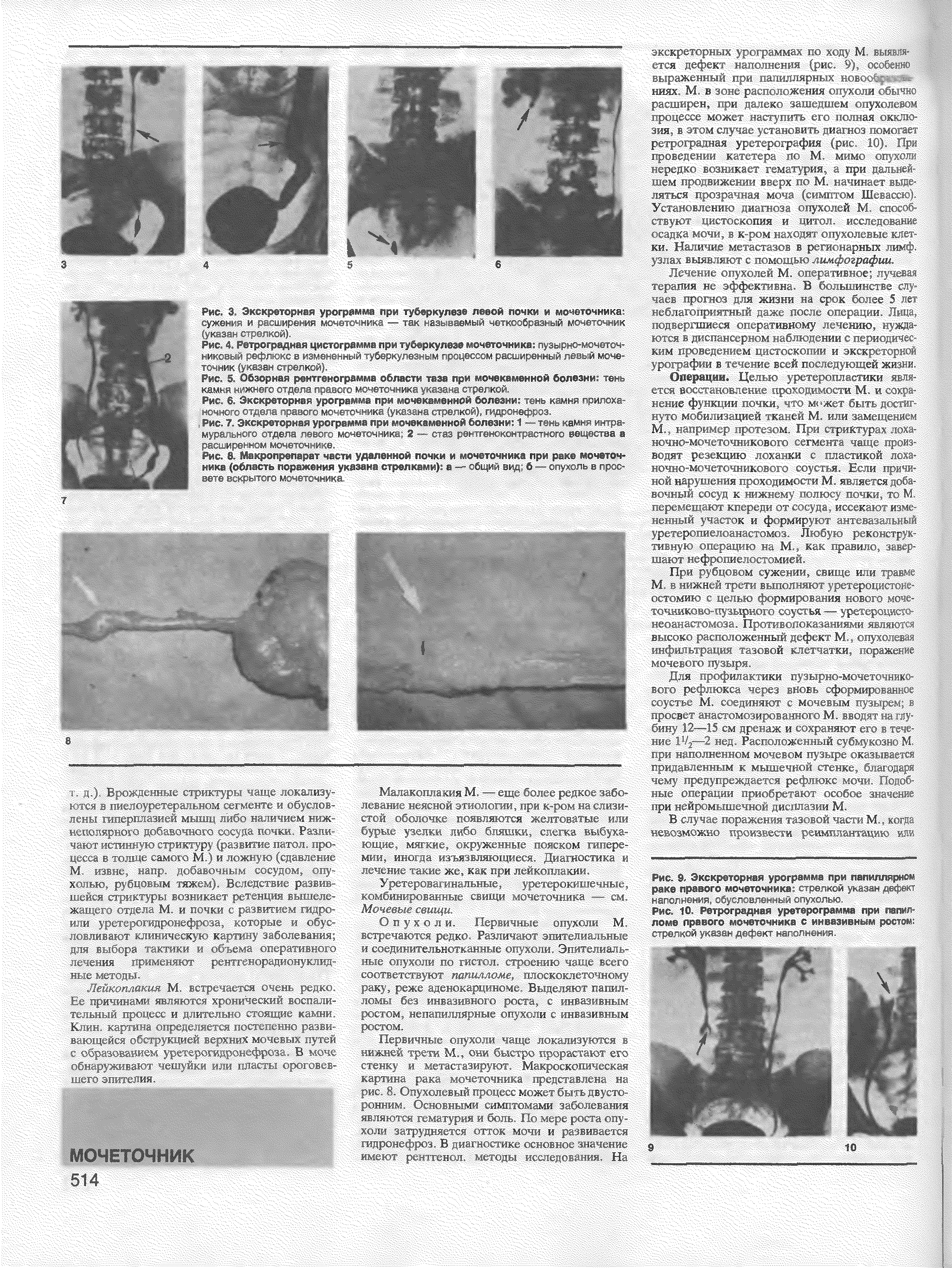 Рис. 7. Экскреторная урограмма при мочекаменной болезни 1 -- тень камин интра. м1 -> > тд и. (< ь< мьчвр ,ник 2 -. пе > < тноги вещытва а расширенном мочеточнике.