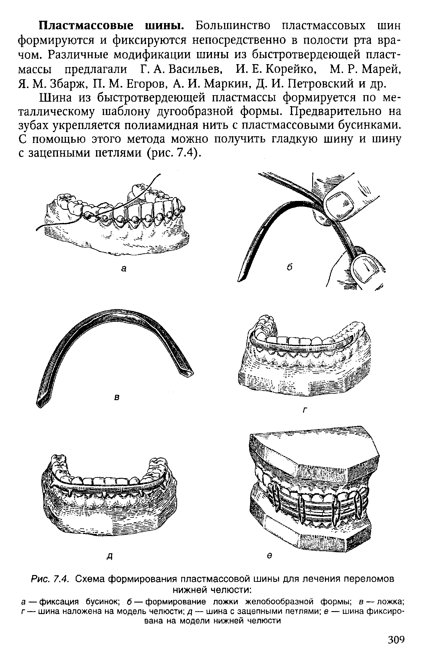 Рис. 7.4. Схема формирования пластмассовой шины для лечения переломов нижней челюсти ...