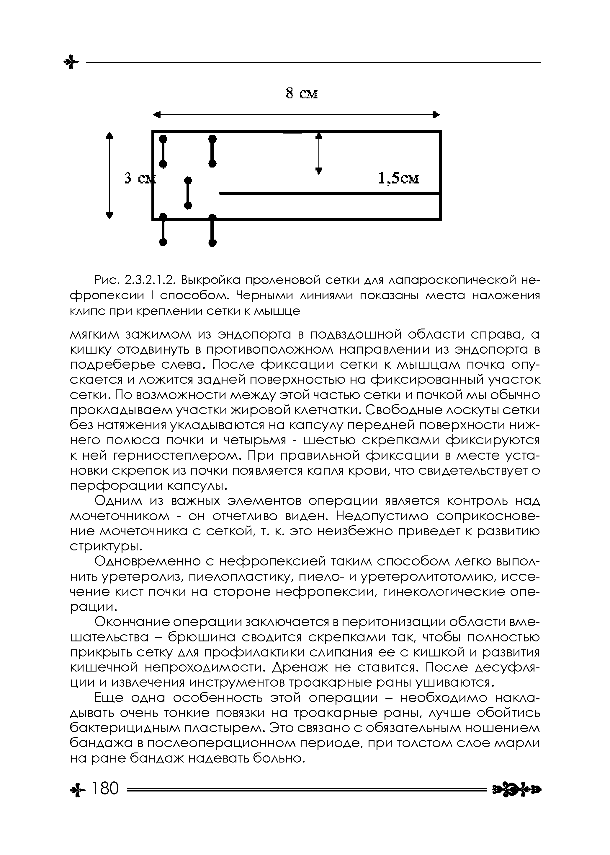 Рис. 2.3.2.1.2. Выкройка проленовой сетки для лапароскопической не-фропексии I способом. Черными линиями показаны места наложения клипс при креплении сетки к мышце...