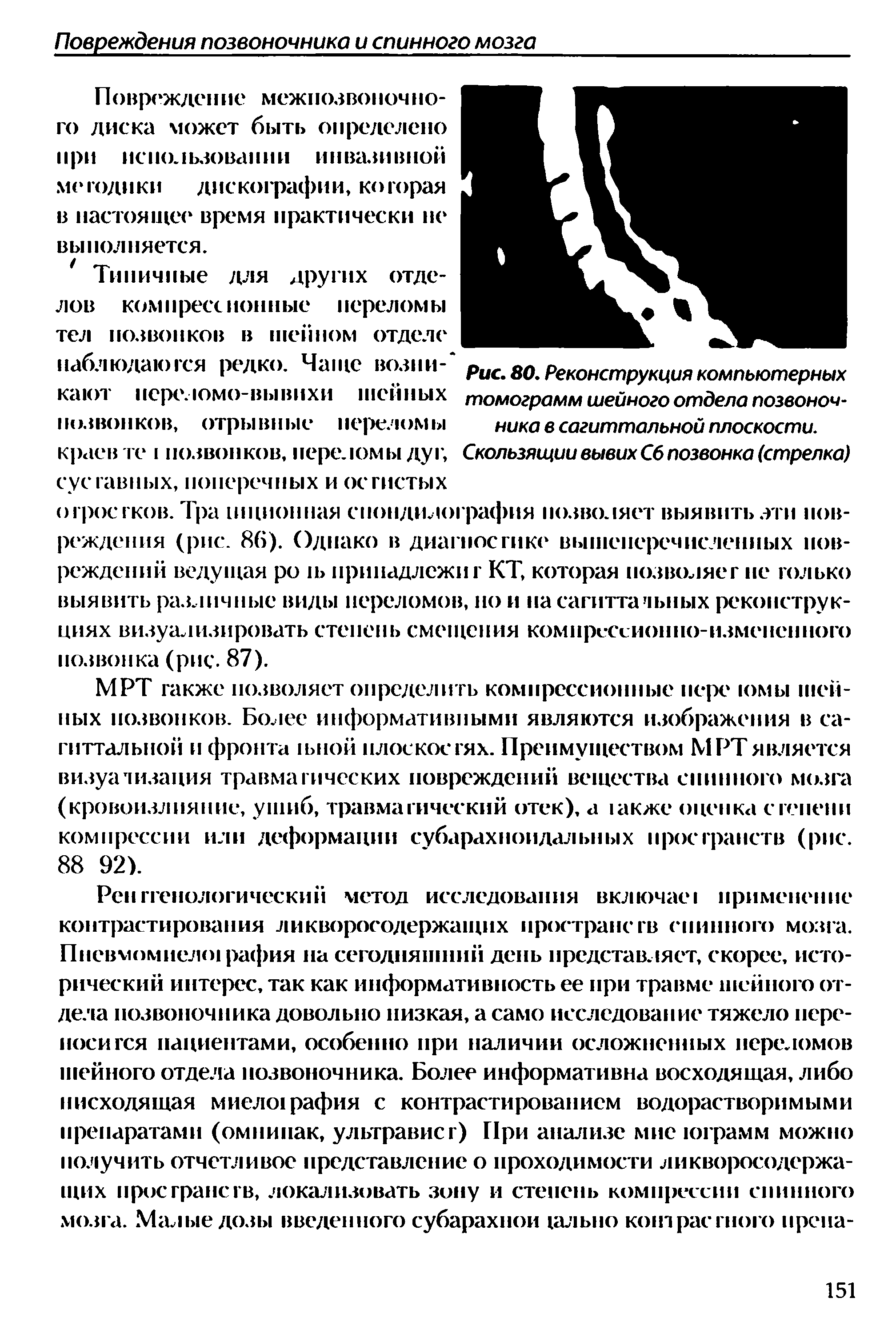 Рис. 80. Реконструкция компьютерных томограмм шейного отдела позвоночника в сагиттальной плоскости.