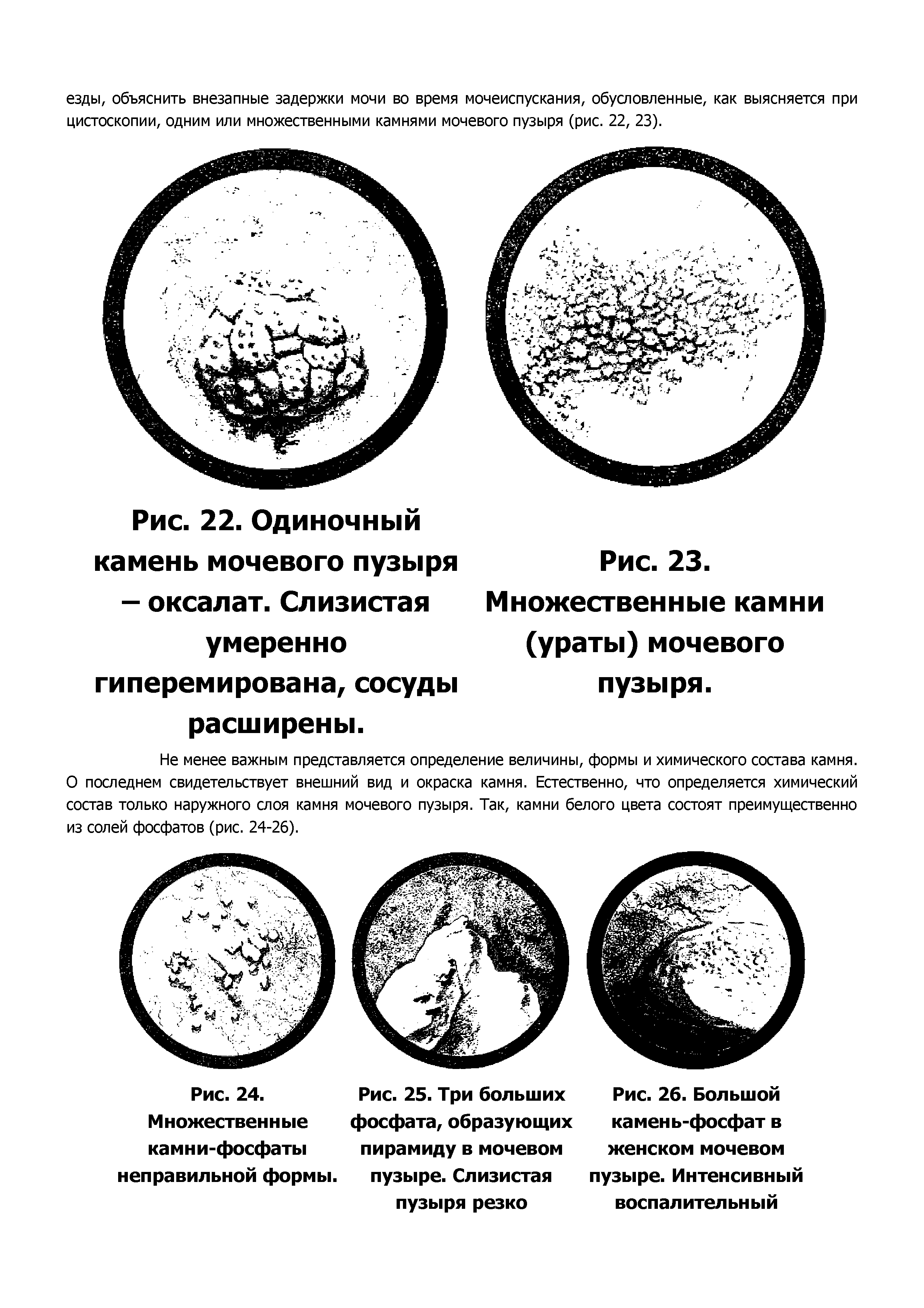 Рис. 26. Большой камень-фосфат в женском мочевом пузыре. Интенсивный воспалительный...