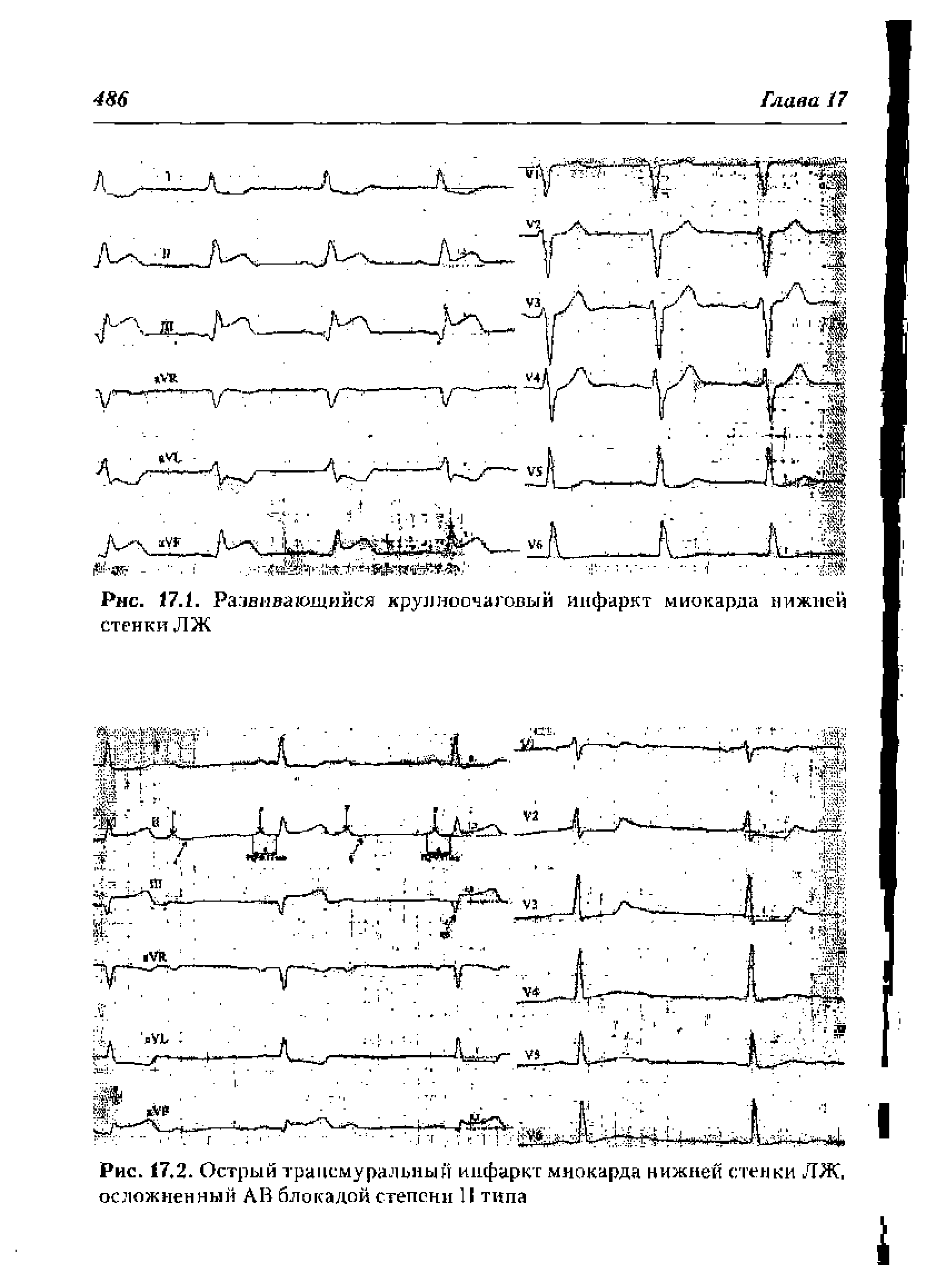 Рис. 17.2. Острый трансмуральный инфаркт миокарда нижней стенки ЛЖ, осложненный АВ блокадой степени II типа...