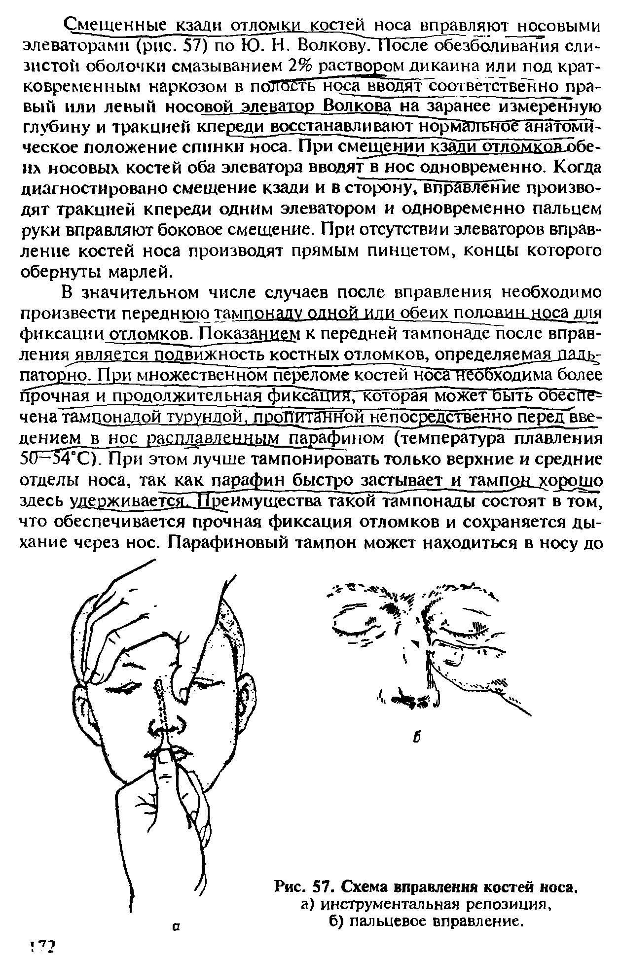 Рис. 57. Схема вправления костей носа, а) инструментальная репозиция, б) пальцевое вправление.