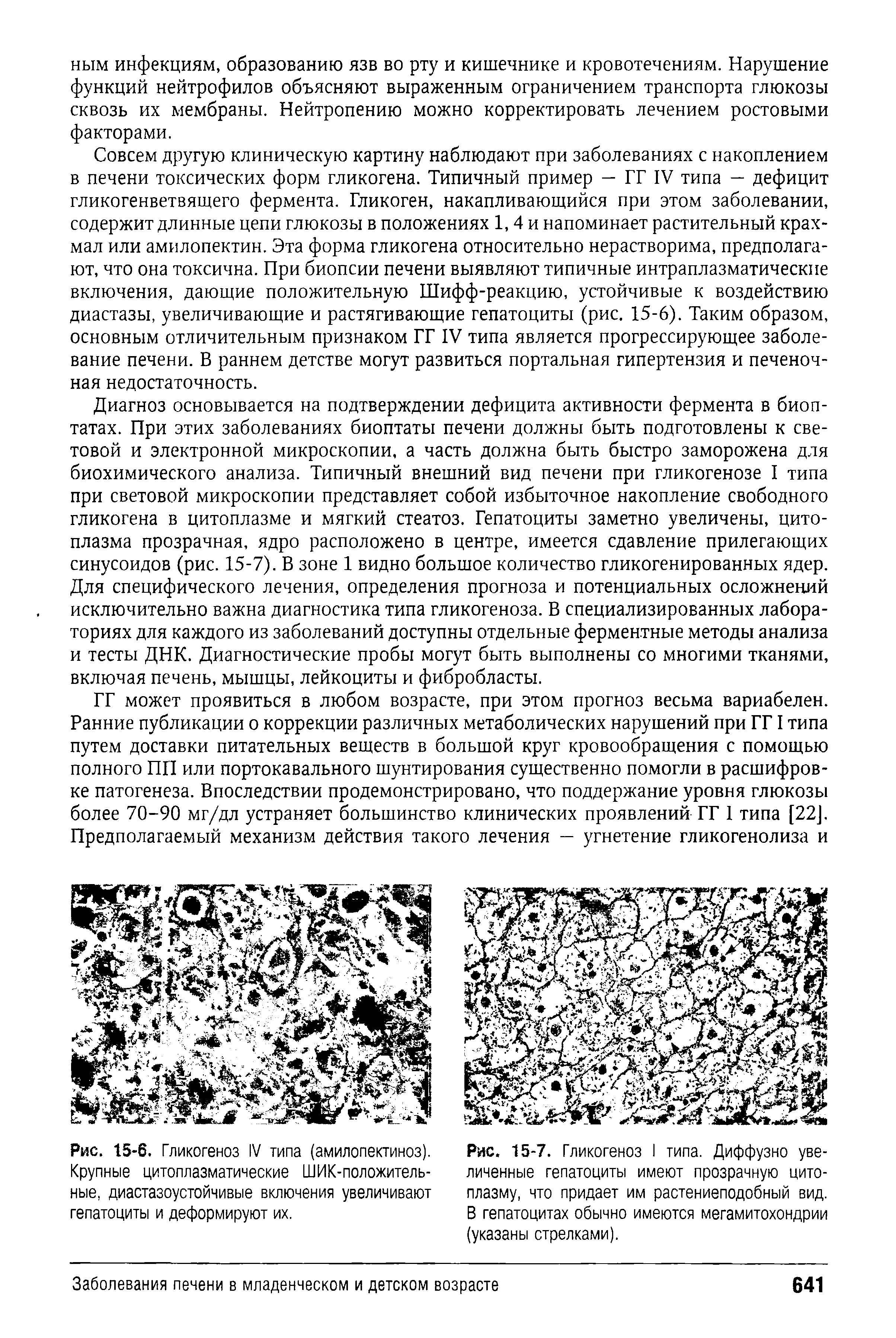 Рис. 15-6. Гликогеноз IV типа (амилопектиноз). Крупные цитоплазматические ШИК-положитель-ные, диастазоустойчивые включения увеличивают гепатоциты и деформируют их.