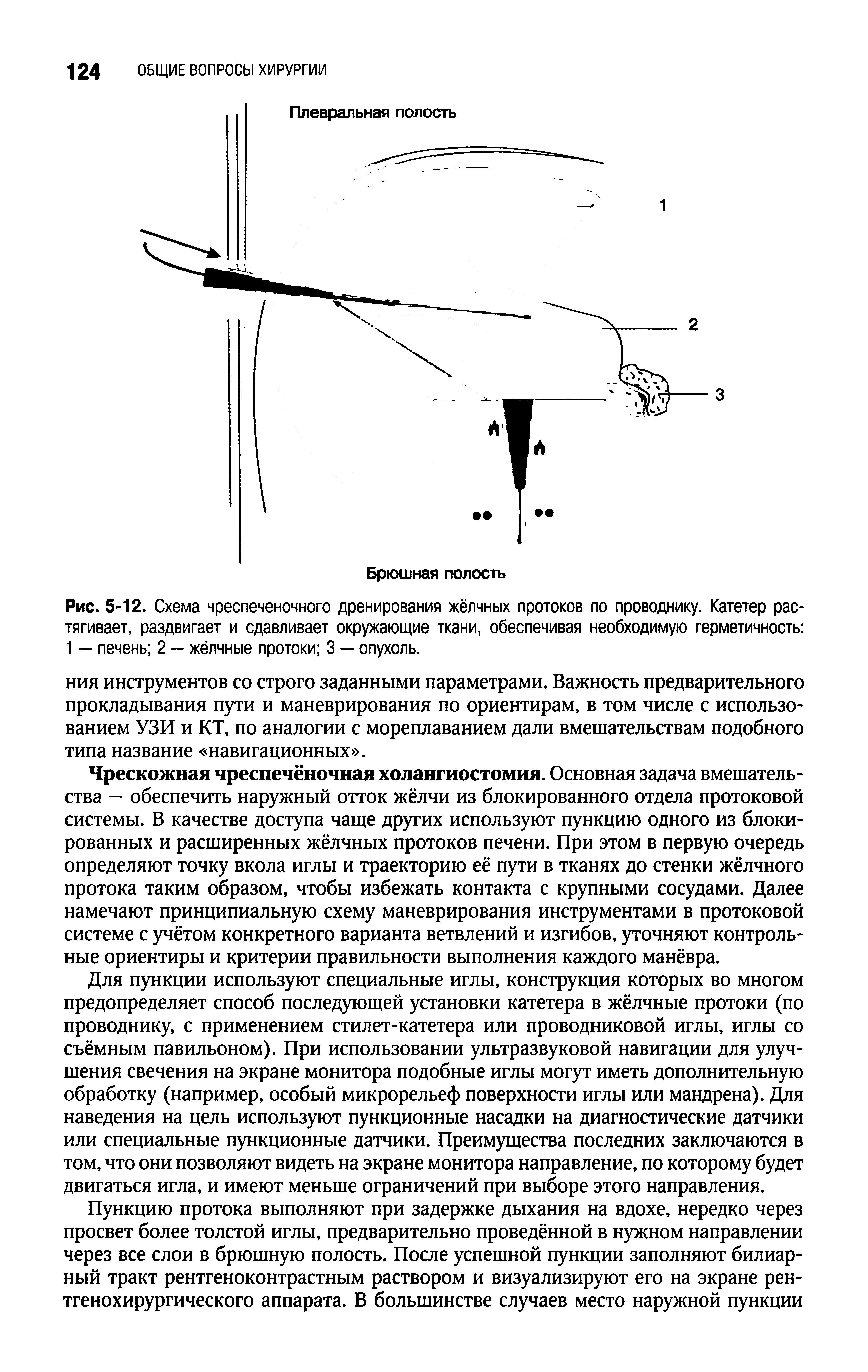 Рис. 5-12. Схема чреспеченочного дренирования жёлчных протоков по проводнику. Катетер растягивает, раздвигает и сдавливает окружающие ткани, обеспечивая необходимую герметичность 1 — печень 2 — жёлчные протоки 3 — опухоль.