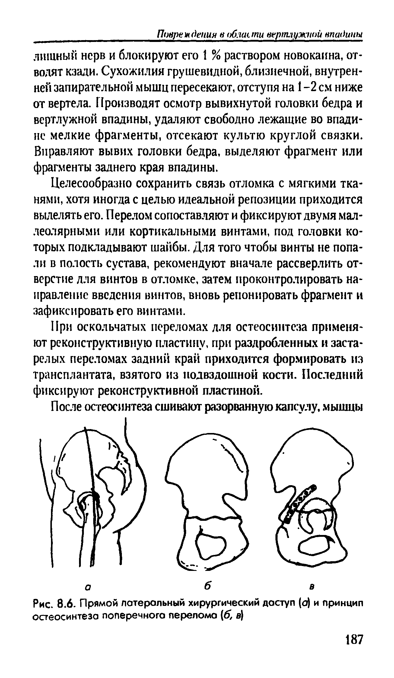 Рис. 8.6. Прямой латеральный хирургический доступ (а) и принцип остеосинтеза поперечного перелома б, в)...