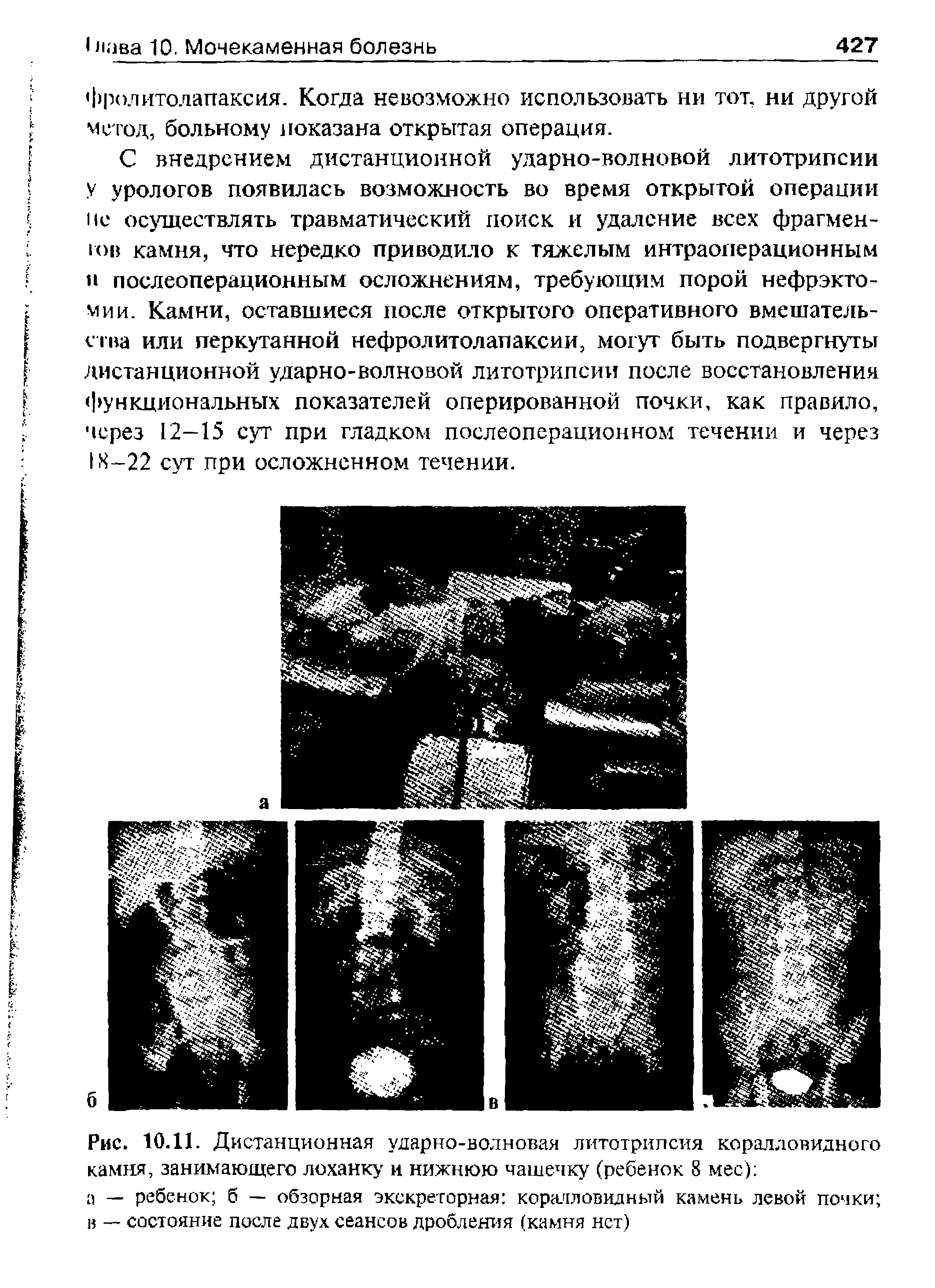 Рис. 10.11. Дистанционная ударно-волновая литотрипсия коралловидного камня, занимающего лоханку и нижнюю чашечку (ребенок 8 мес) ...