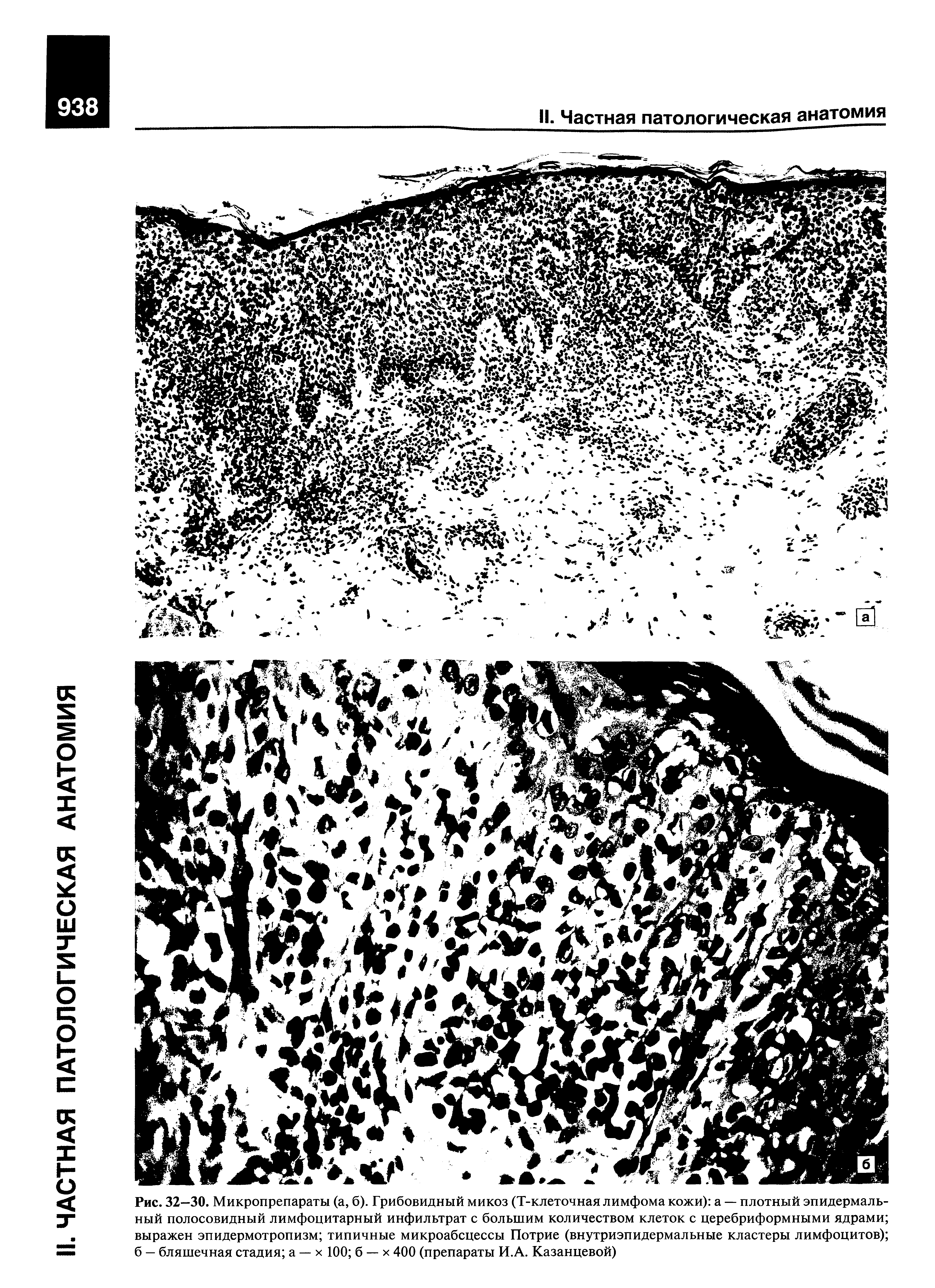 Рис. 32—30. Микропрепараты (а, б). Грибовидный микоз (Т-клеточная лимфома кожи) а — плотный эпидермальный полосовидный лимфоцитарный инфильтрат с большим количеством клеток с церебриформными ядрами выражен эпидермотропизм типичные микроабсцессы Потрие (внутриэпидермальные кластеры лимфоцитов) б — бляшечная стадия а — х 100 б — х 400 (препараты И.А. Казанцевой)...