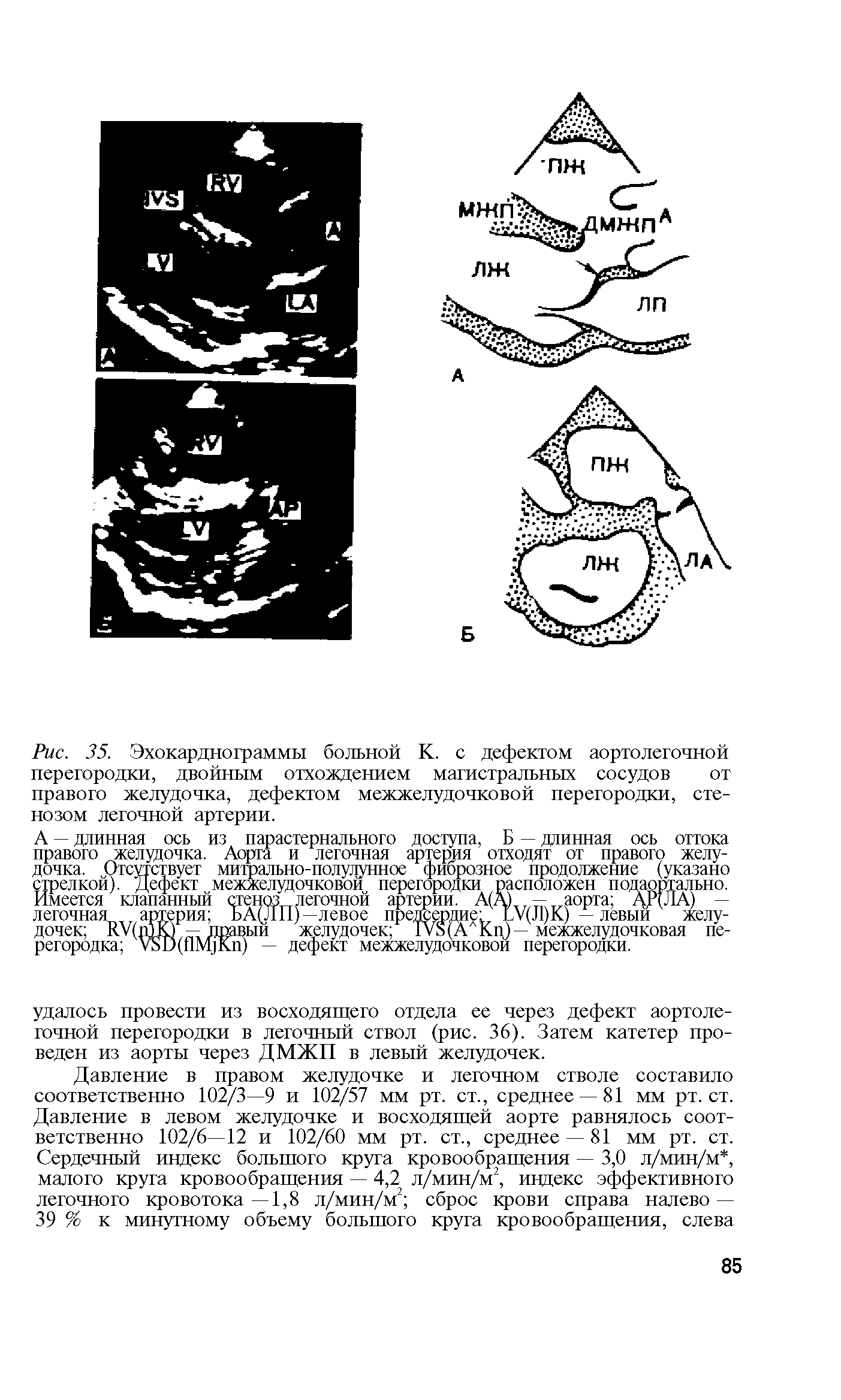 Рис. 35. Эхокардиограммы больной К. с дефектом аортолегочной перегородки, двойным отхождением магистральных сосудов от правого желудочка, дефектом межжелудочковой перегородки, стенозом легочной артерии.