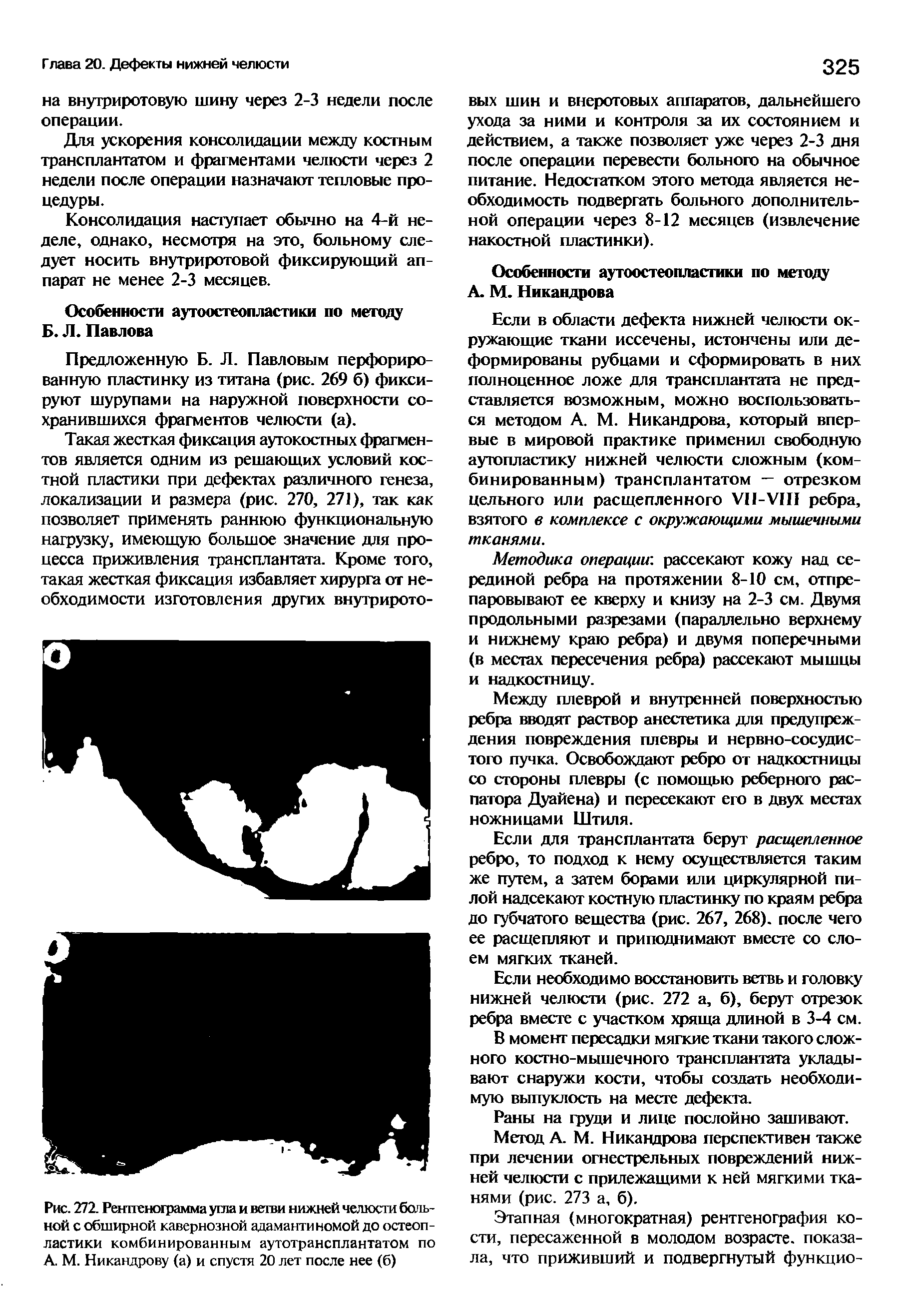 Рис. 272. Рентгенограмма угла и ветви нижней челюсти больной с обширной кавернозной адамантиномой до остеопластики комбинированным аутотрансплантатом по А. М. Никандрову (а) и спустя 20 лет после нее (б)...