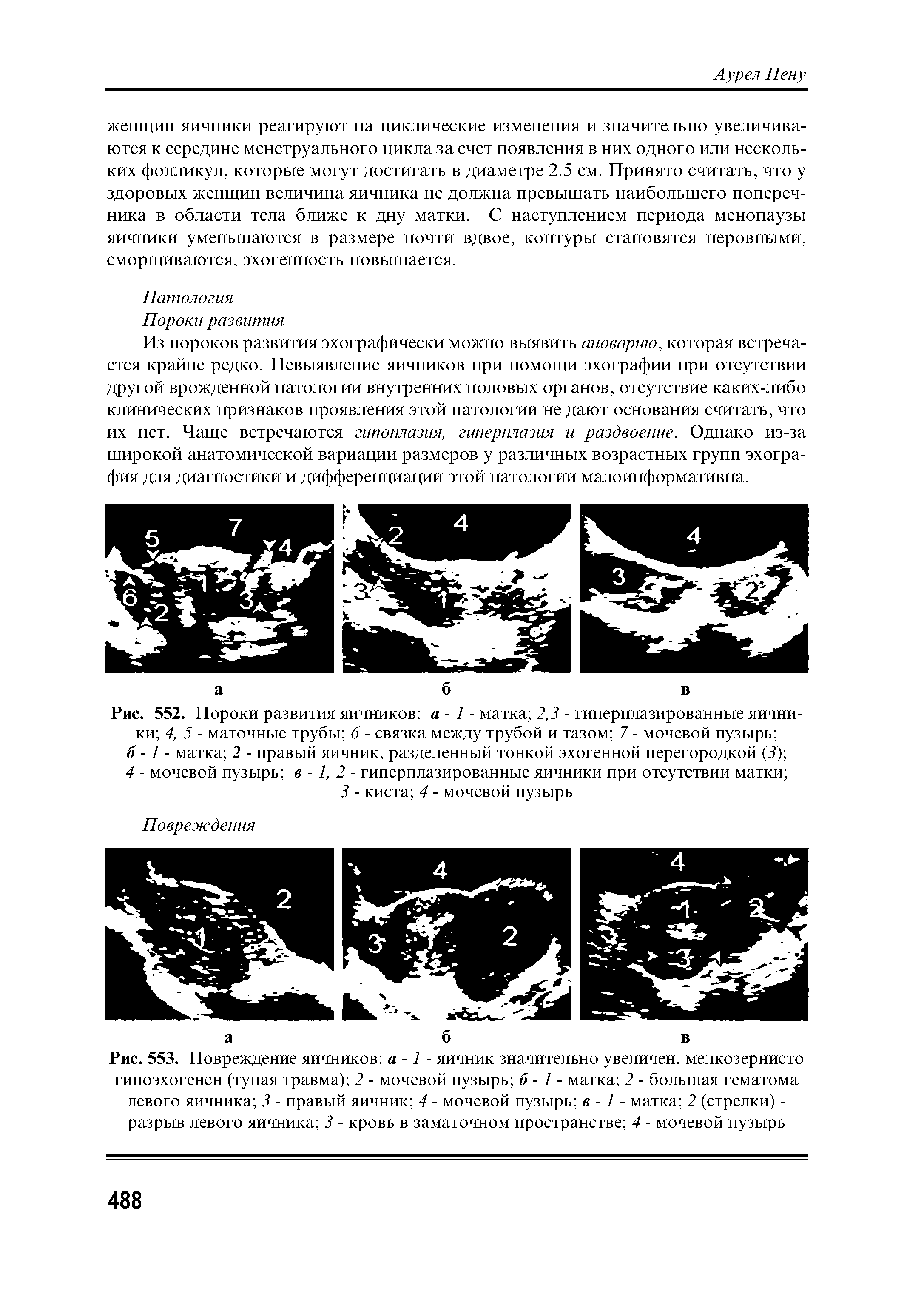 Рис. 552. Пороки развития яичников а - 1 - матка 2,3 - гиперплазированные яичники 4, 5 - маточные трубы 6 - связка между трубой и тазом 7 - мочевой пузырь ...