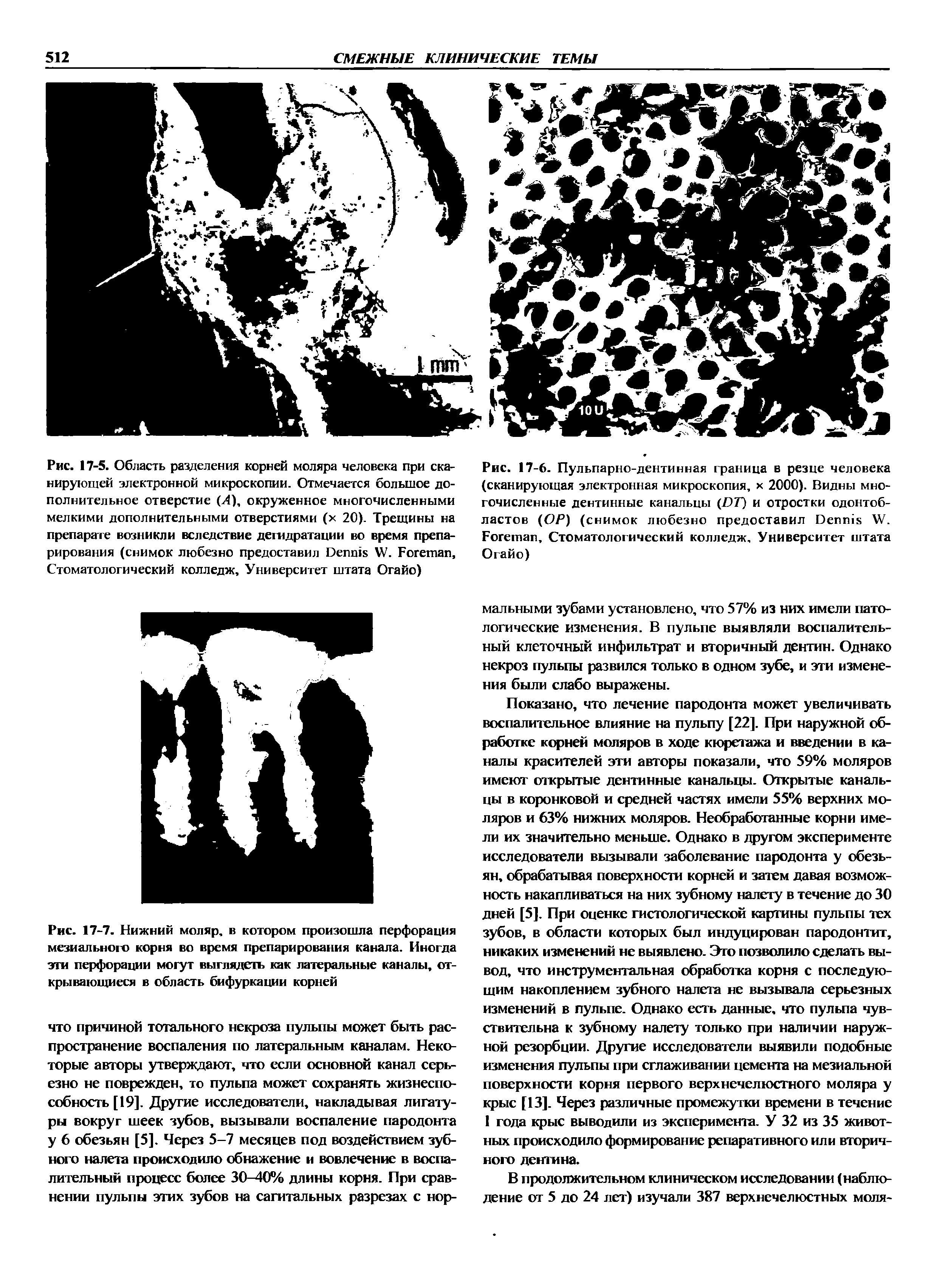 Рис. 17-6. Пульпарно-дентинная граница в резце человека (сканирующая электронная микроскопия, х 2000). Видны многочисленные дентинные канальцы (DT) и отростки одонтобластов (ОР) (снимок любезно предоставил D W. F , Стоматологический колледж. Университет штата Огайо)...