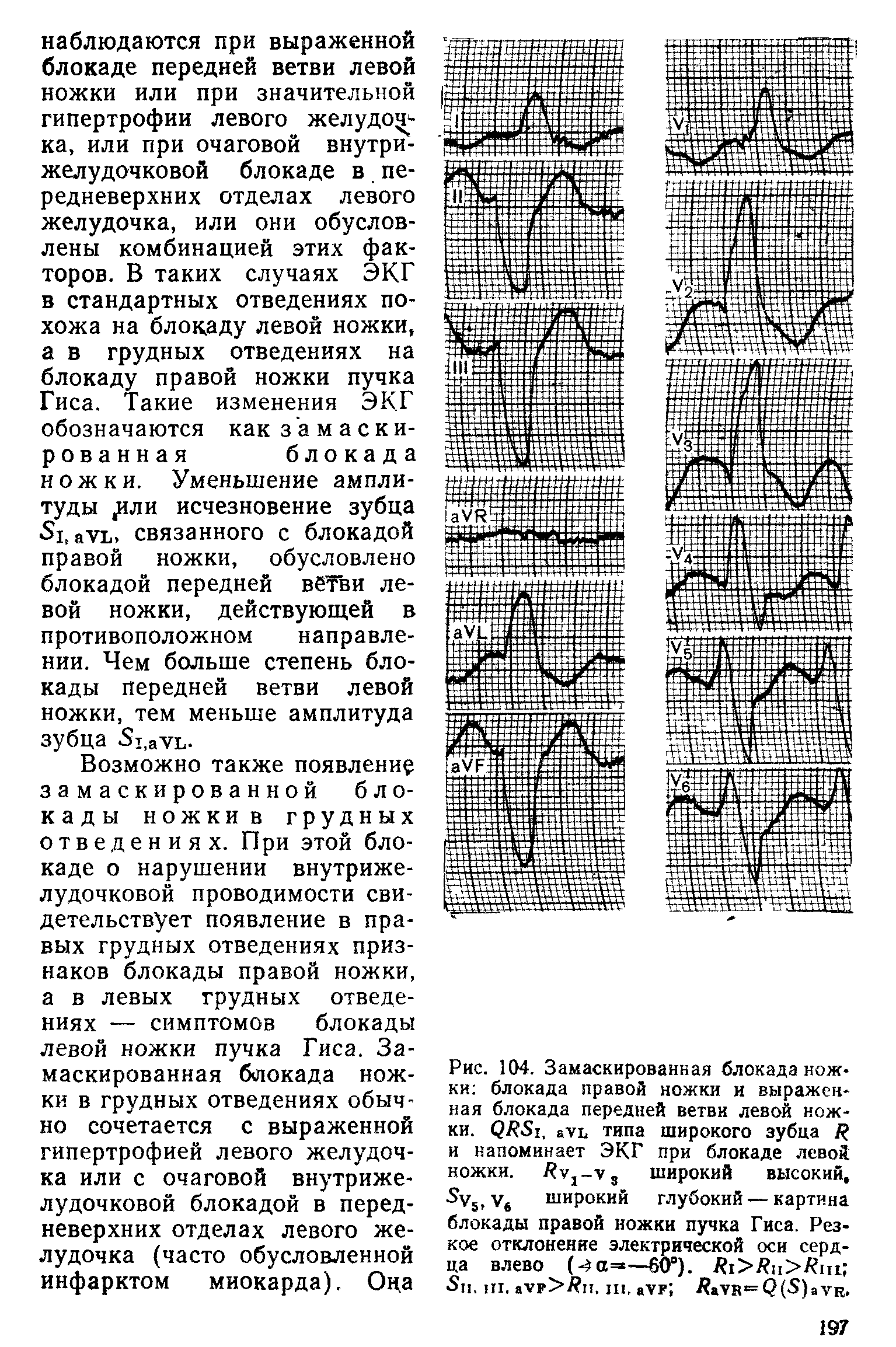 Рис. 104. Замаскированная блокада ножки блокада правой ножки и выраженная блокада передней ветви левой ножки. ауц типа широкого зубца %...