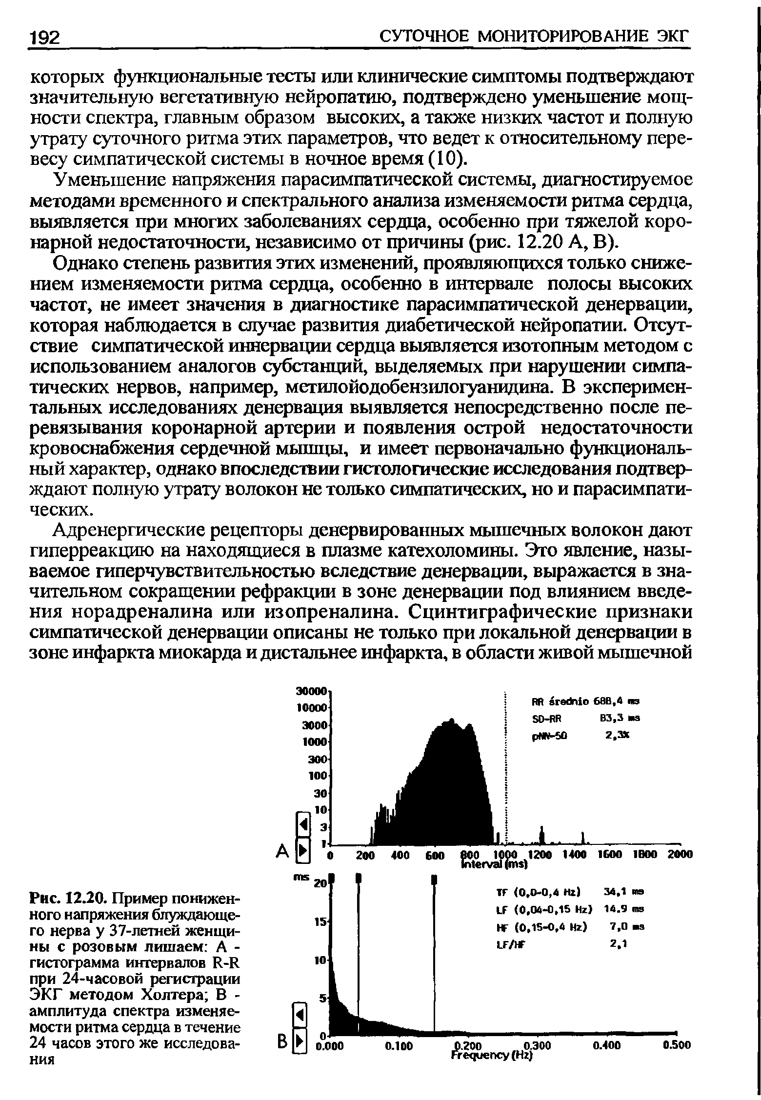 Рис. 12.20. Пример пониженного напряжения блуждающего нерва у 37-летней женщины с розовым лишаем А -гистограмма интервалов Й-И при 24-часовой регистрации ЭКГ методом Холтера В -амплитуда спектра изменяемости ритма сердца в течение 24 часов этого же исследования...