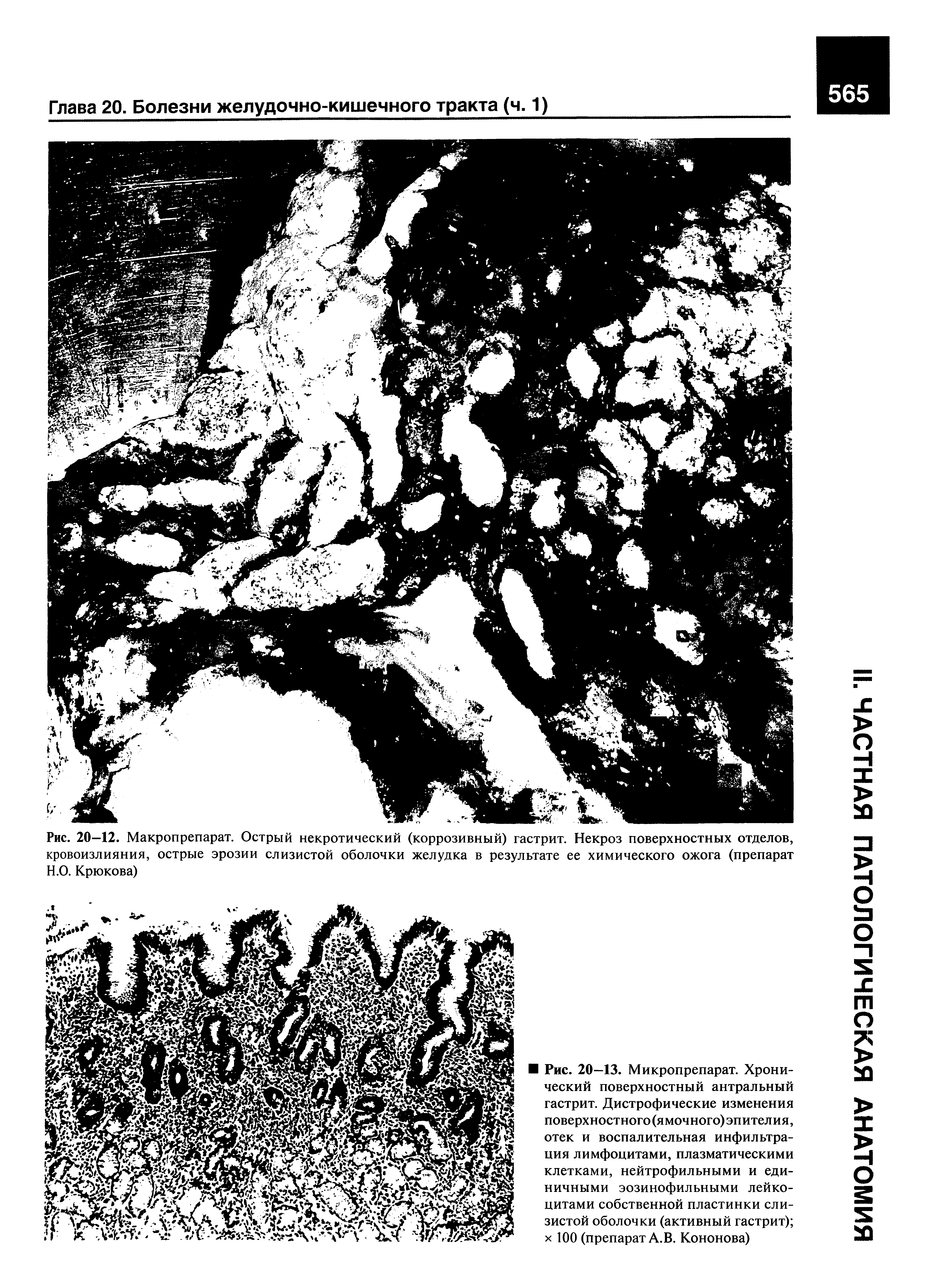 Рис. 20—12. Макропрепарат. Острый некротический (коррозивный) гастрит. Некроз поверхностных отделов, кровоизлияния, острые эрозии слизистой оболочки желудка в результате ее химического ожога (препарат Н.О. Крюкова)...