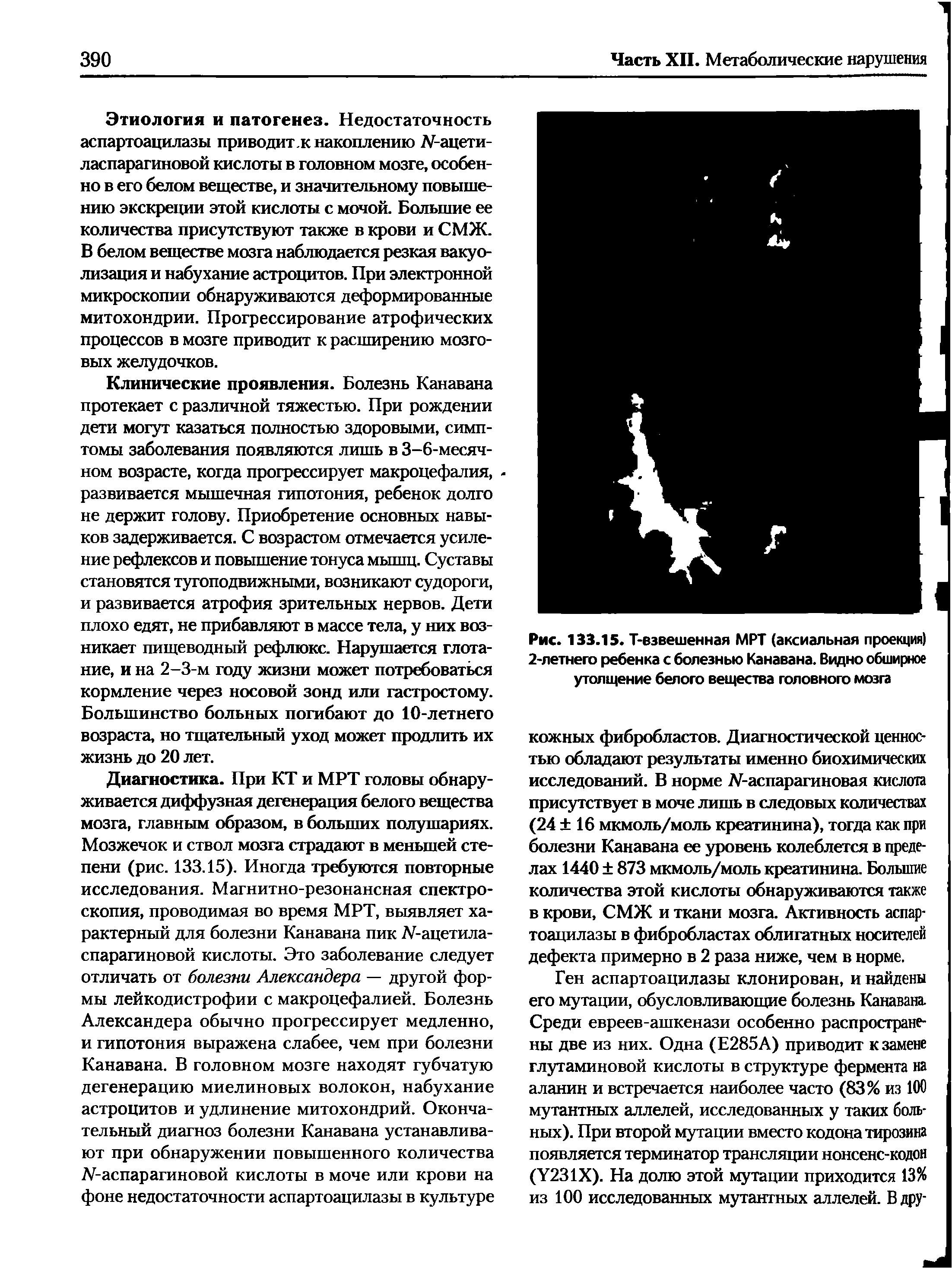 Рис. 133.15. Т-взвешенная МРТ (аксиальная проекция) 2-летнего ребенка с болезнью Канавана. Видно обширное утолщение белого вещества головного мозга...