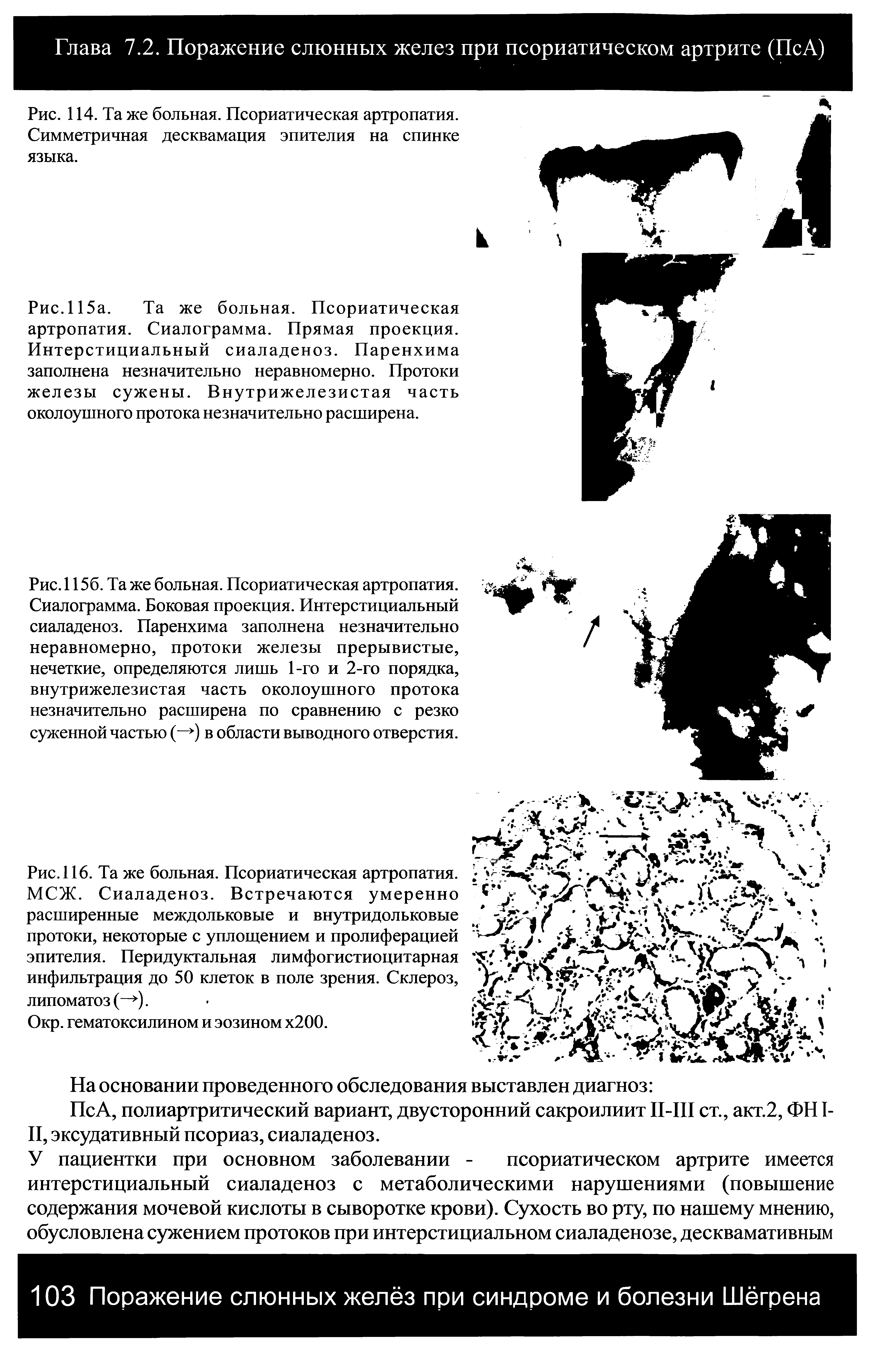 Рис.115а. Та же больная. Псориатическая артропатия. Сиалограмма. Прямая проекция. Интерстициальный сиаладеноз. Паренхима заполнена незначительно неравномерно. Протоки железы сужены. Внутрижелезистая часть околоушного протока незначительно расширена.