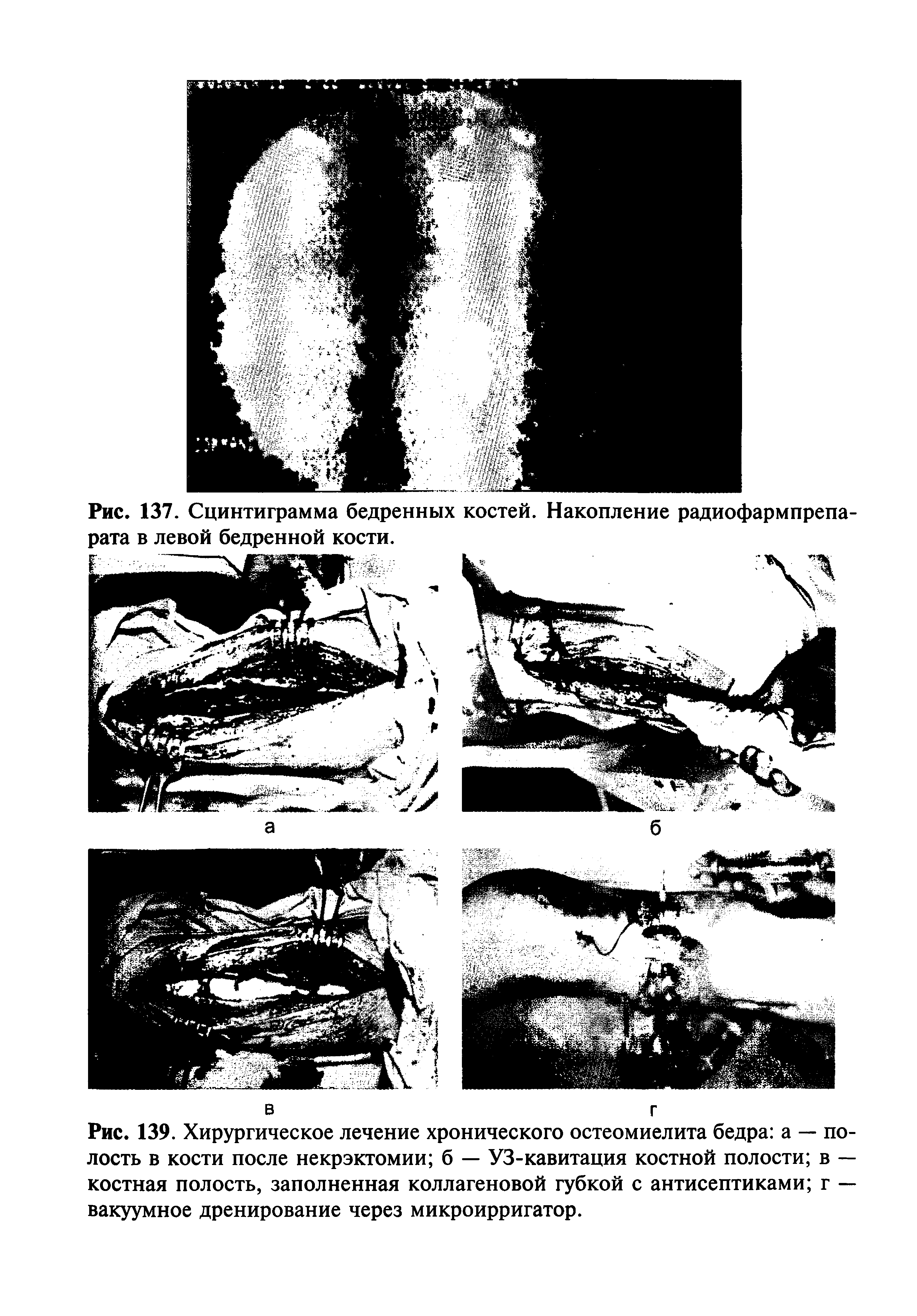 Рис. 139. Хирургическое лечение хронического остеомиелита бедра а — полость в кости после некрэктомии б — УЗ-кавитация костной полости в — костная полость, заполненная коллагеновой губкой с антисептиками г — вакуумное дренирование через микроирригатор.