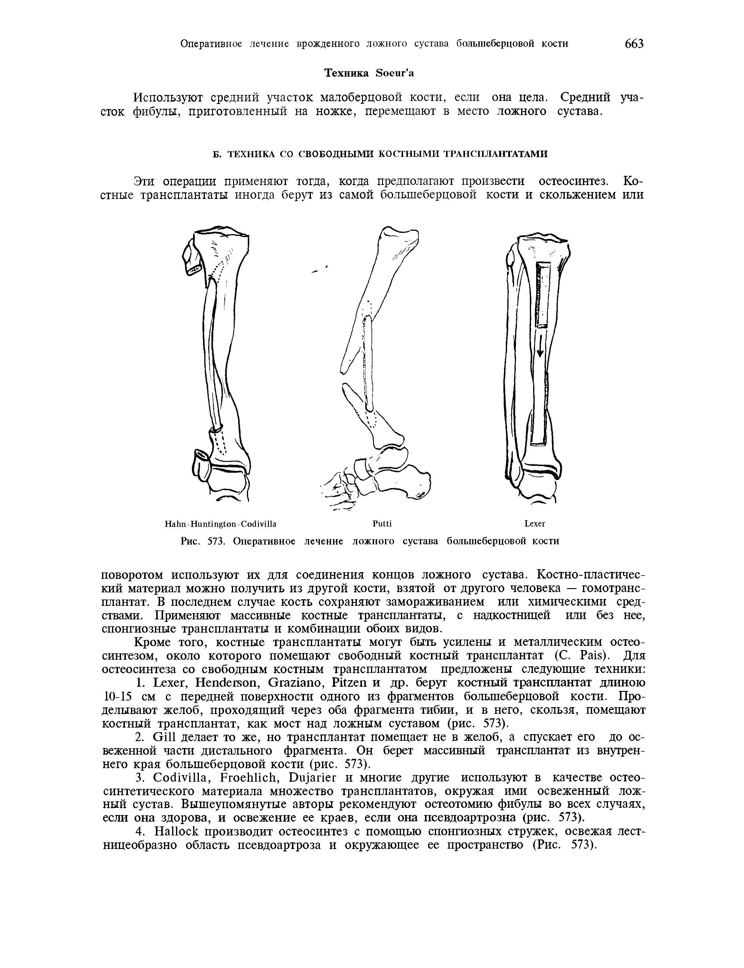 Рис. 573. Оперативное лечение ложного сустава большеберцовой кости...