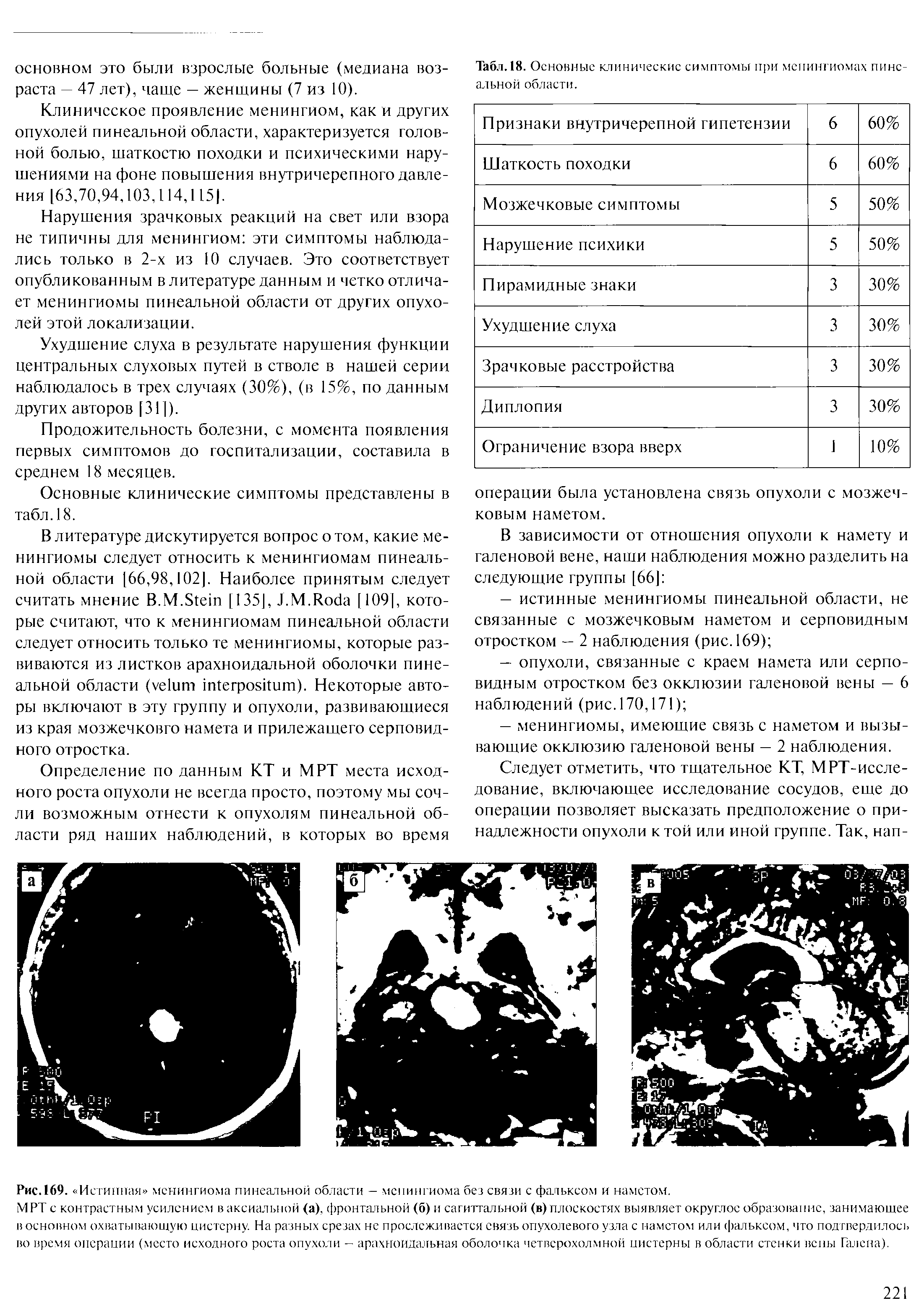 Рис.169. Истинная менингиома пинеальной области - менингиома без связи с фальксом и намстом.