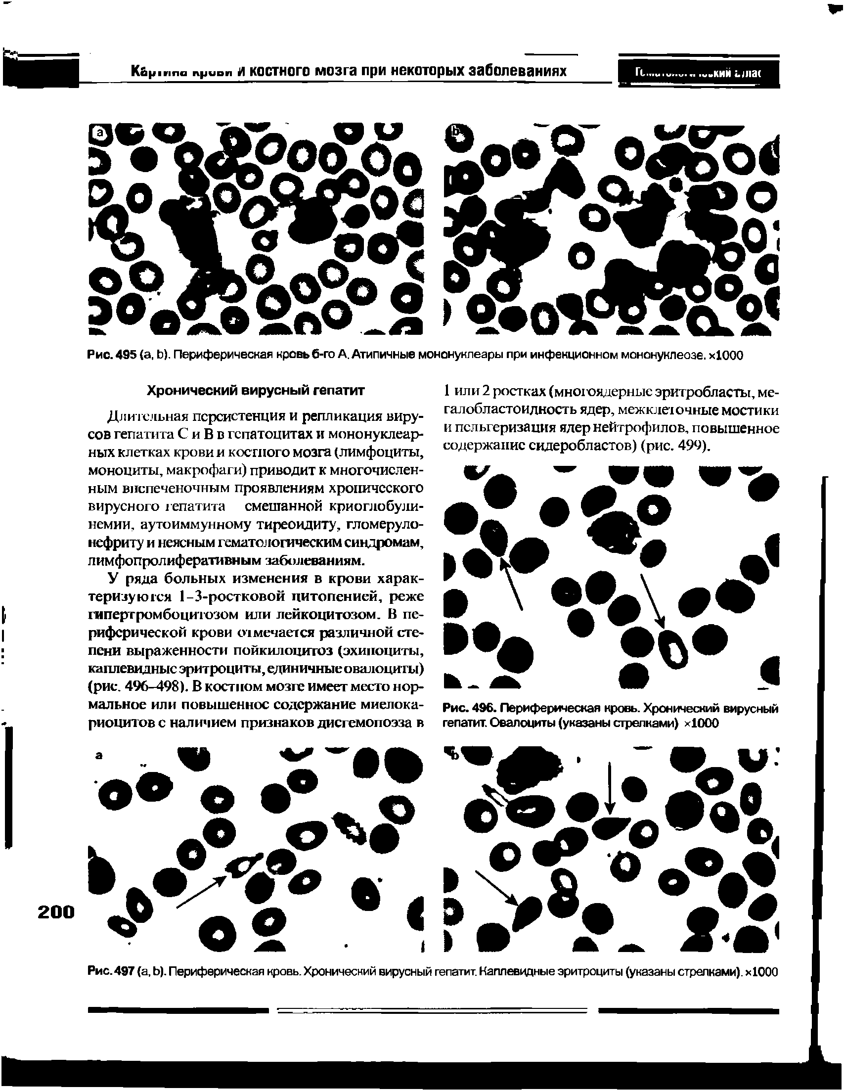 Рис. 496. Периферическая кровь. Хронический вирусный гепатит. Овалоциты (указаны стрелками) 1000...