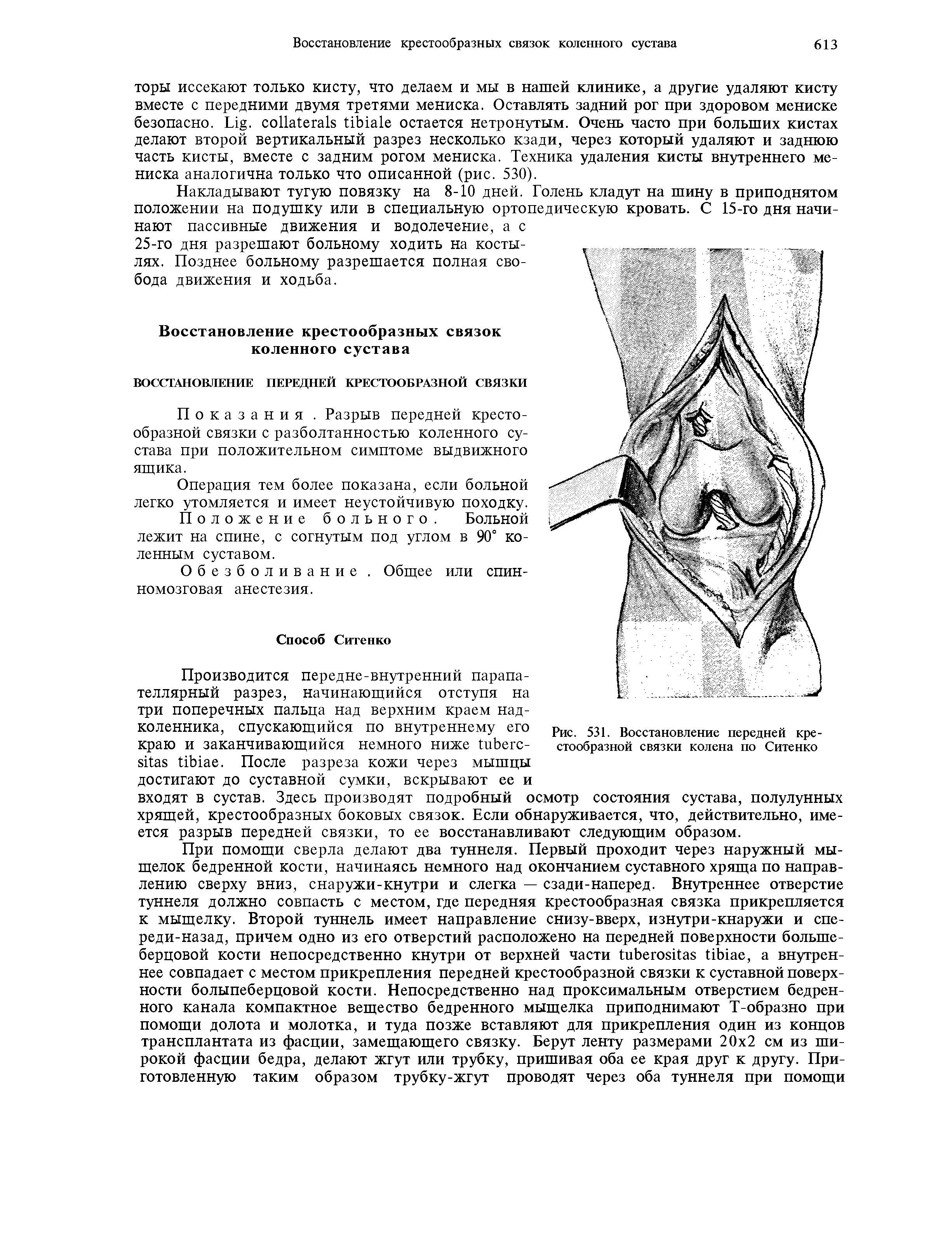 Рис. 531. Восстановление передней крестообразной связки колена по Ситенко...