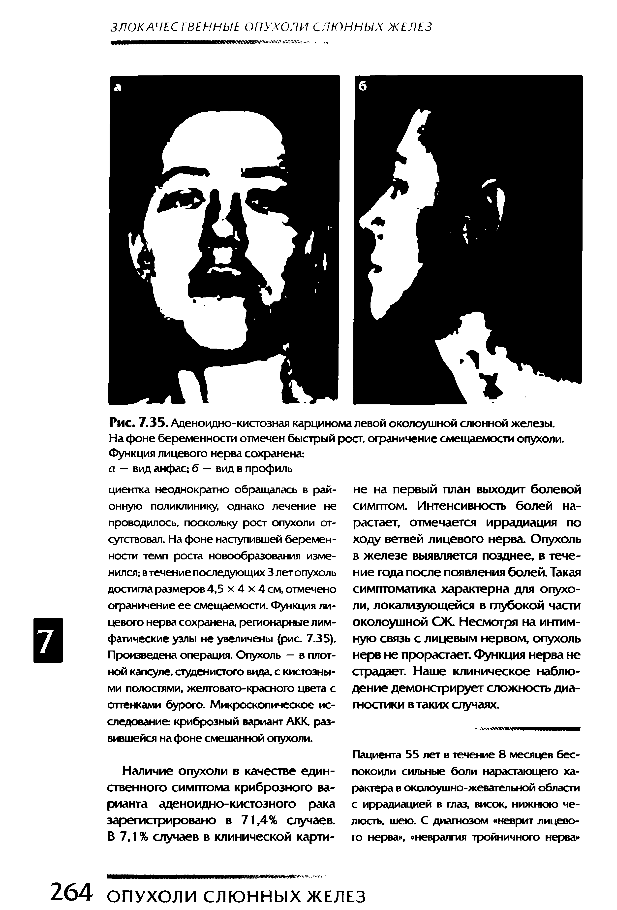 Рис. 7.35. Аденоидно-кистозная карцинома левой околоушной слюнной железы. На фоне беременности отмечен быстрый рост, ограничение смещаемости опухоли. Функция лицевого нерва сохранена а — вид анфас б — вид в профиль...