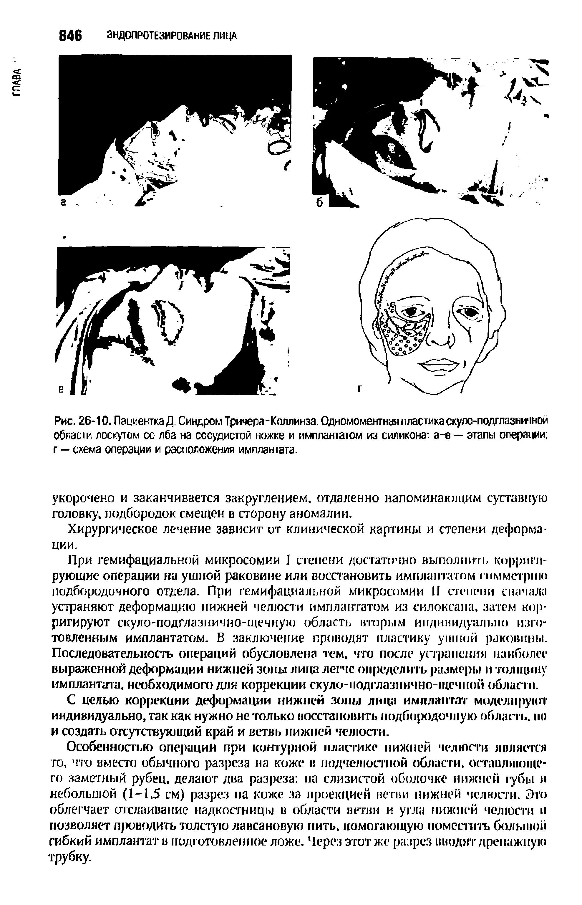 Рис. 26-10. ПациенткаД. Синдром Тричера-Коллинза Одномоментная пластика скуло-подглазничной области лоскутом со лба на сосудистой ножке и имплантатом из силикона а-е — этапы операции г — схема операции и расположения имплантата.