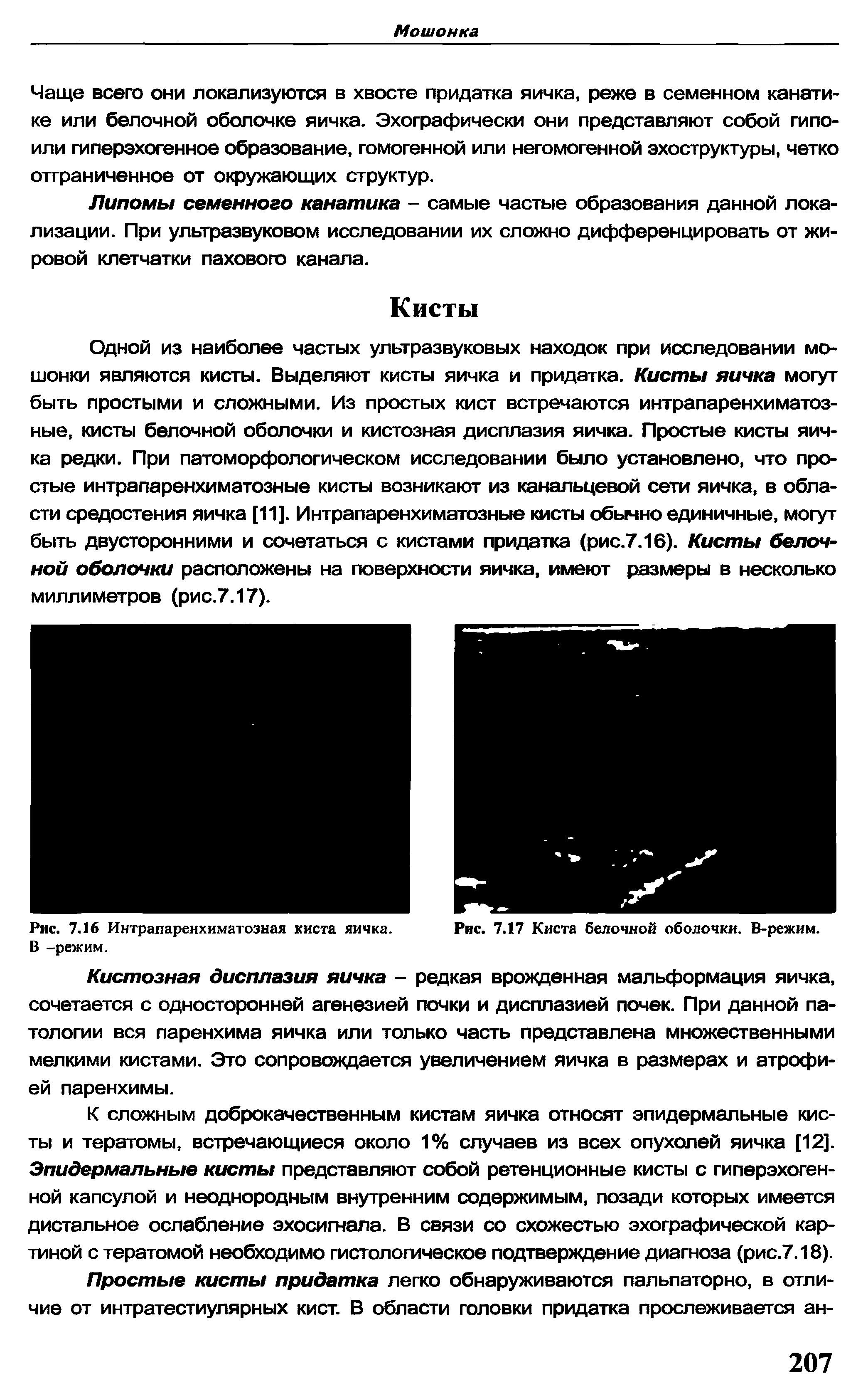 Рис. 7.16 Интрапаренхиматозная киста яичка. Рис. 7.17 Киста белочной оболочки. В-режим.