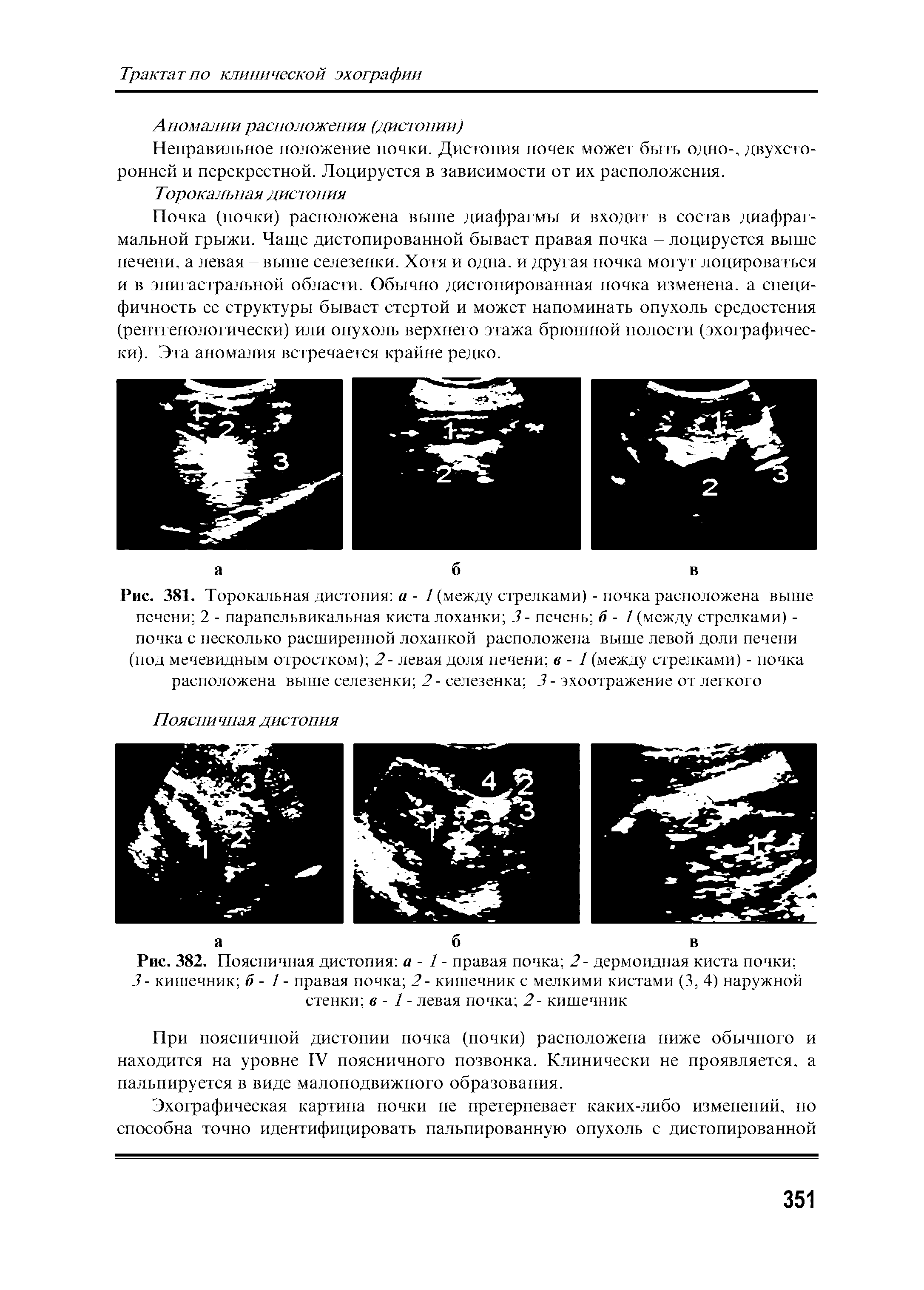 Рис. 382. Поясничная дистопия а - 1 - правая почка 2- дермоидная киста почки 3- кишечник б - 1 - правая почка 2- кишечник с мелкими кистами (3, 4) наружной стенки в - 1 - левая почка 2- кишечник...
