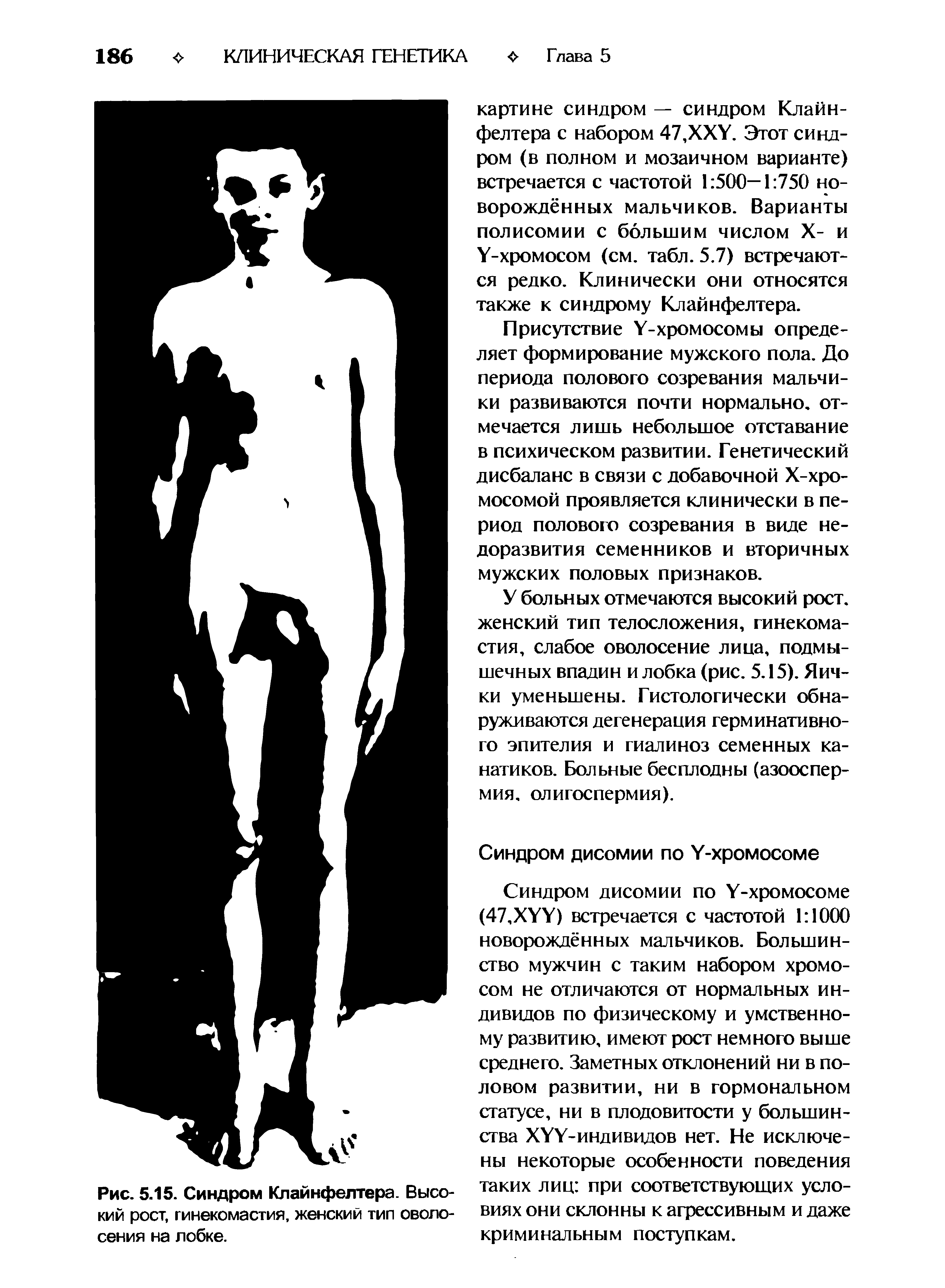 Рис. 5.15. Синдром Клайнфелтера. Высокий рост, гинекомастия, женский тип оволосения на лобке.