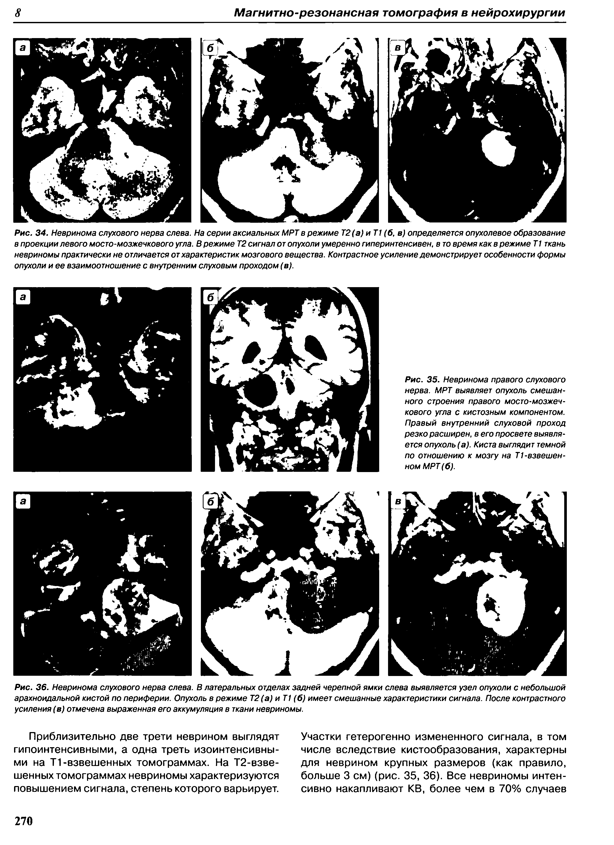 Рис. 35. Невринома правого слухового нерва. МРТ выявляет опухоль смешанного строения правого мосто-мозжечкового угла с кистозным компонентом. Правый внутренний слуховой проход резко расширен, в его просвете выявляется опухоль (а). Киста выглядит темной по отношению к мозгу на Т1-взвешенном МРТ (б).