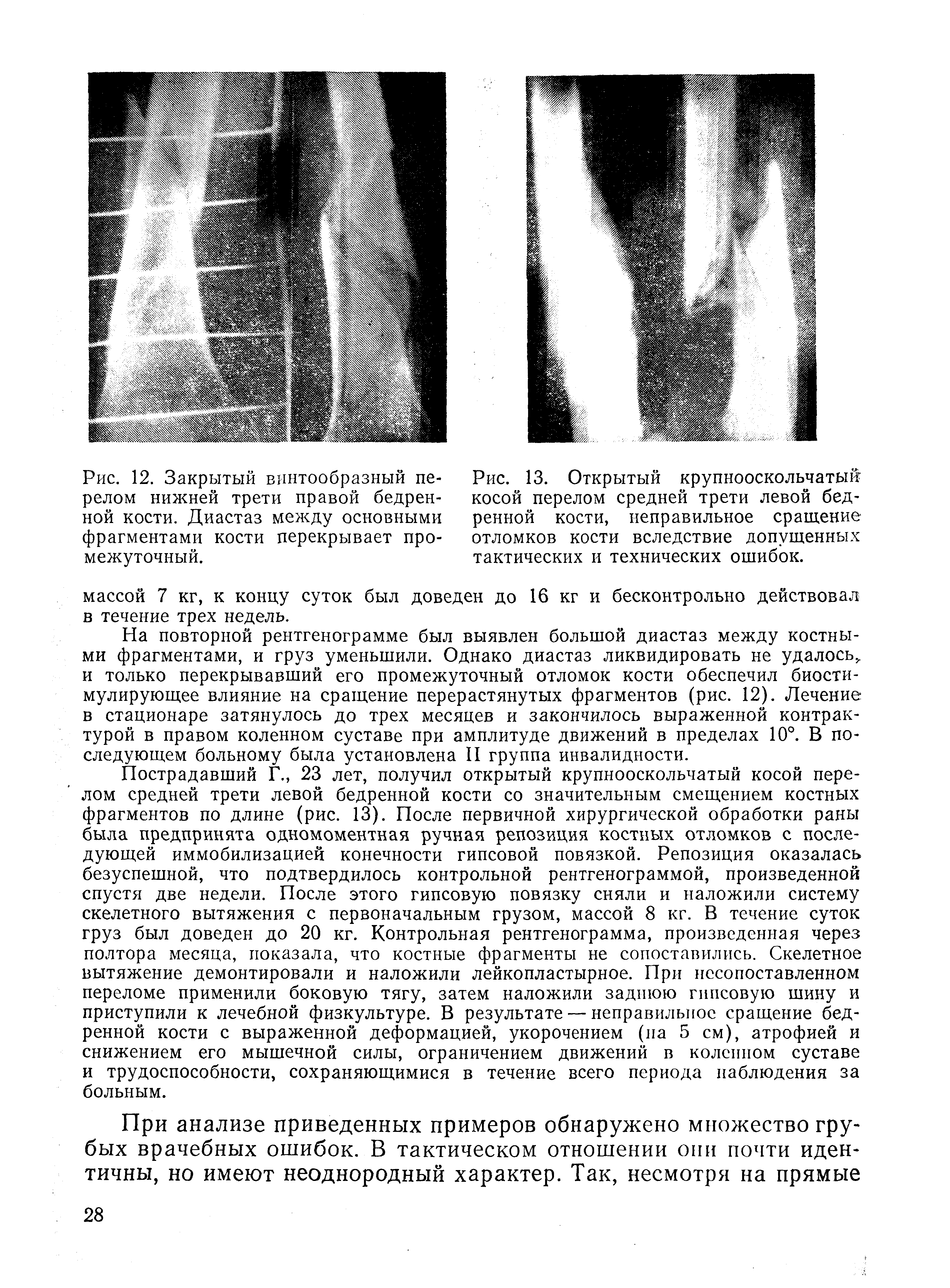 Рис. 12. Закрытый винтообразный перелом нижней трети правой бедренной кости. Диастаз между основными фрагментами кости перекрывает промежуточный.