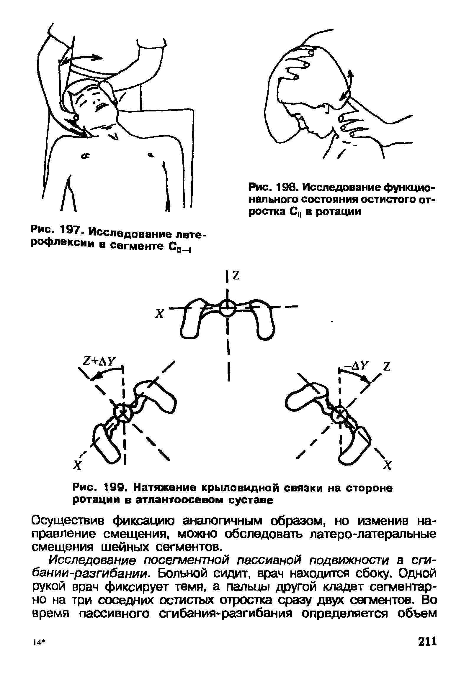 Рис. 199. Натяжение крыловидной связки на стороне ротации в атлантоосевом суставе...