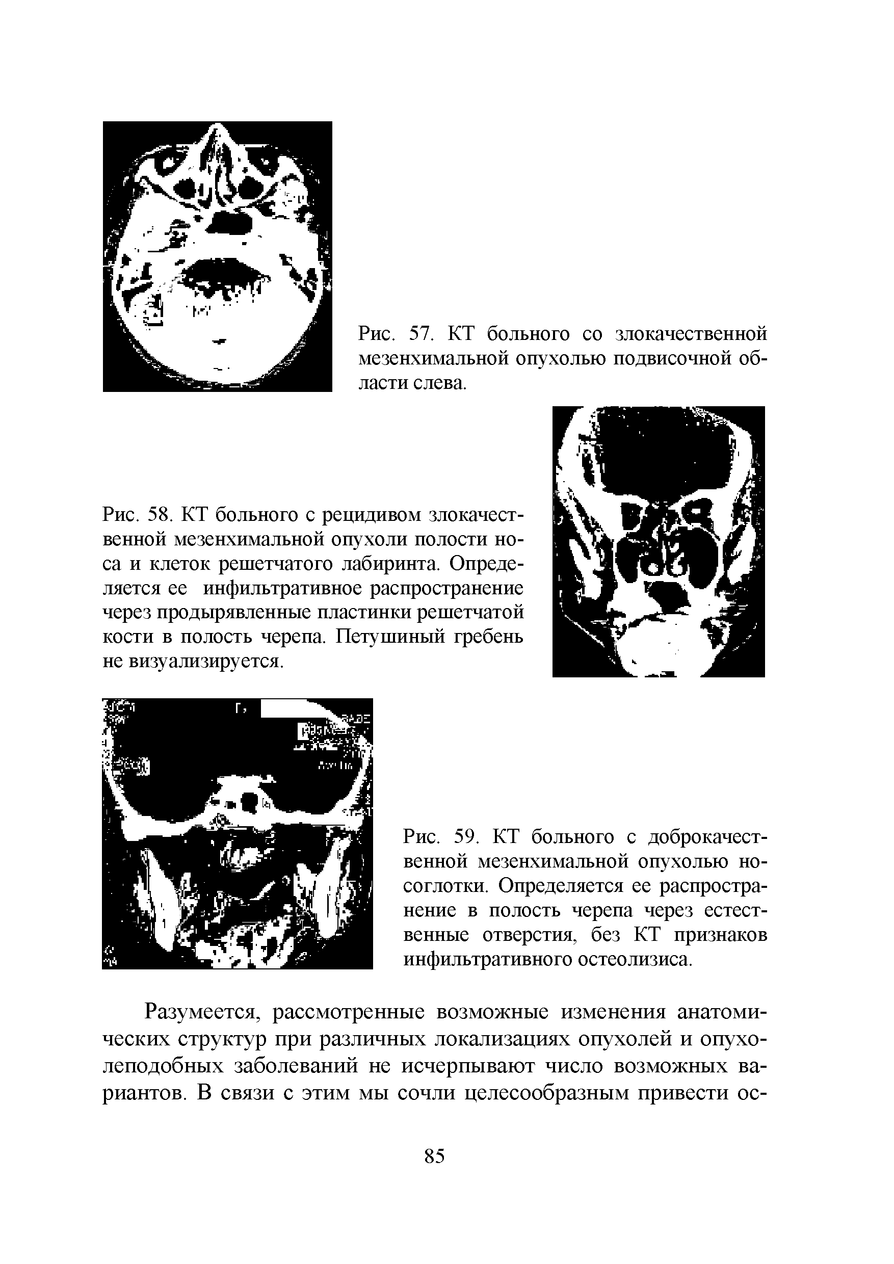 Рис. 59. КТ больного с доброкачественной мезенхимальной опухолью носоглотки. Определяется ее распространение в полость черепа через естественные отверстия, без КТ признаков инфильтративного остеолизиса.