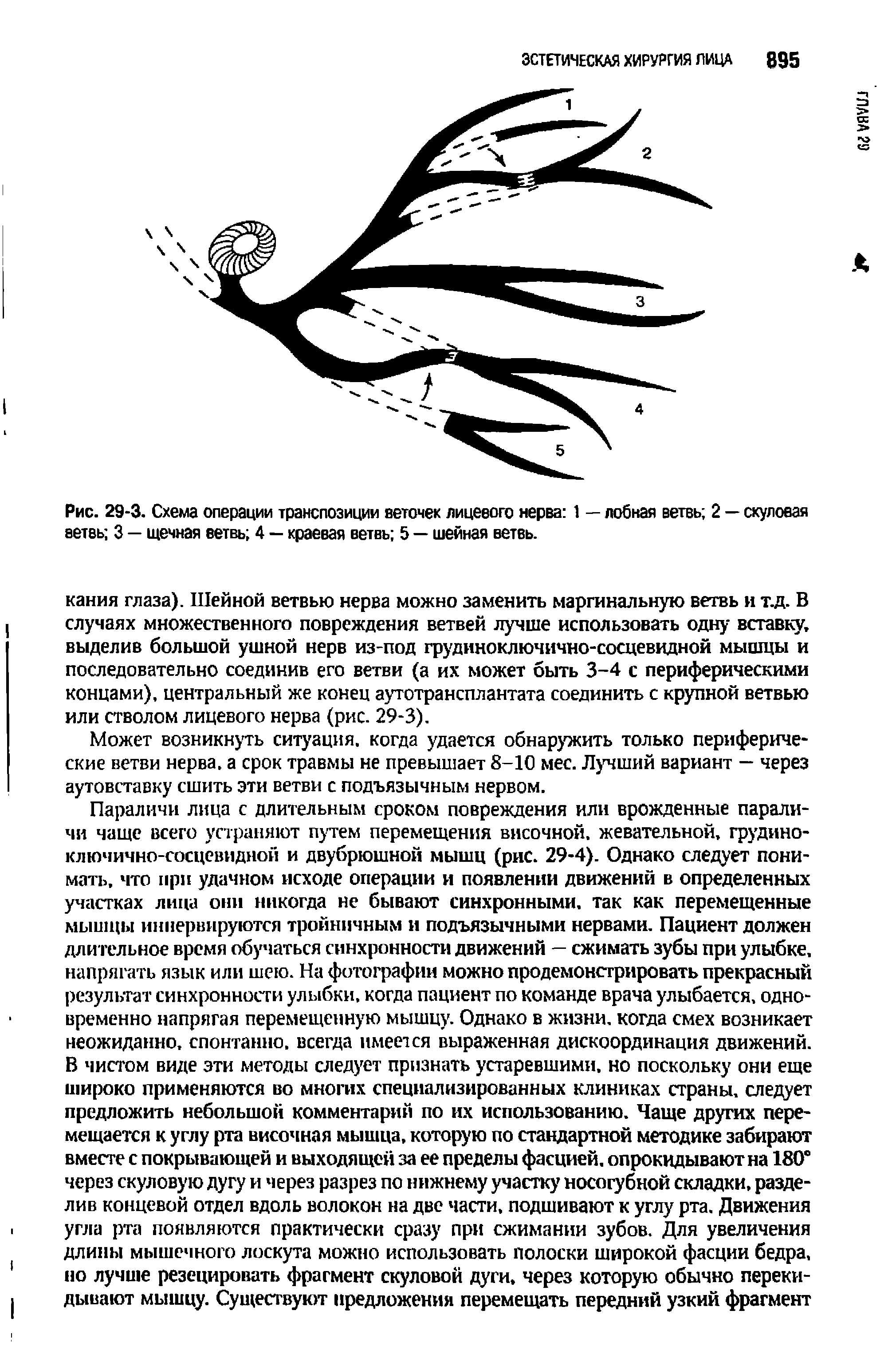 Рис. 29-3. Схема операции транспозиции веточек лицевого нерва 1 — лобная ветвь 2 — скуловая ветвь 3 — щечная ветвь 4 — краевая ветвь 5 — шейная ветвь.