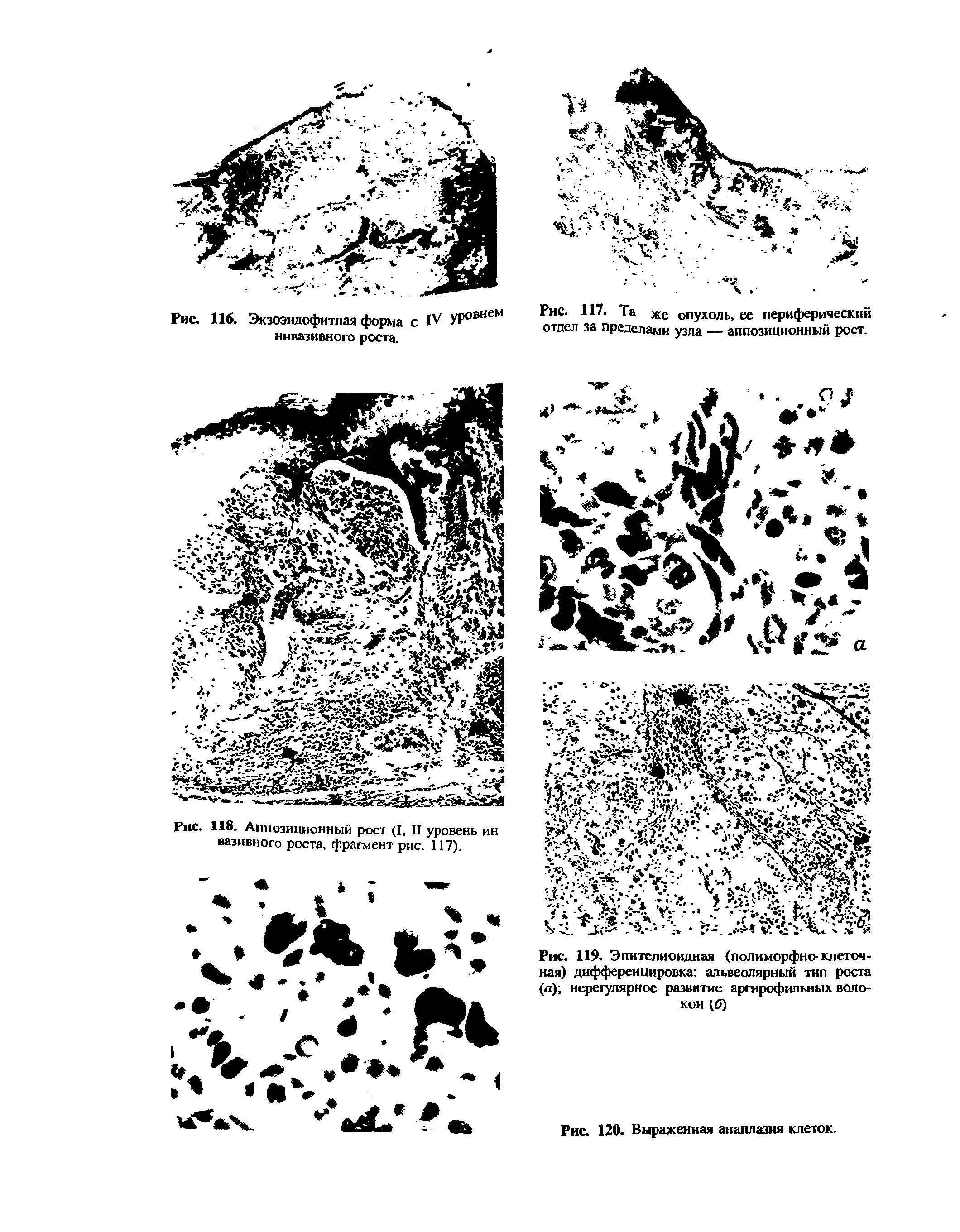 Рис. 117. Та же опухоль, ее периферический отдел за пределами узла — аппозиционный рост.