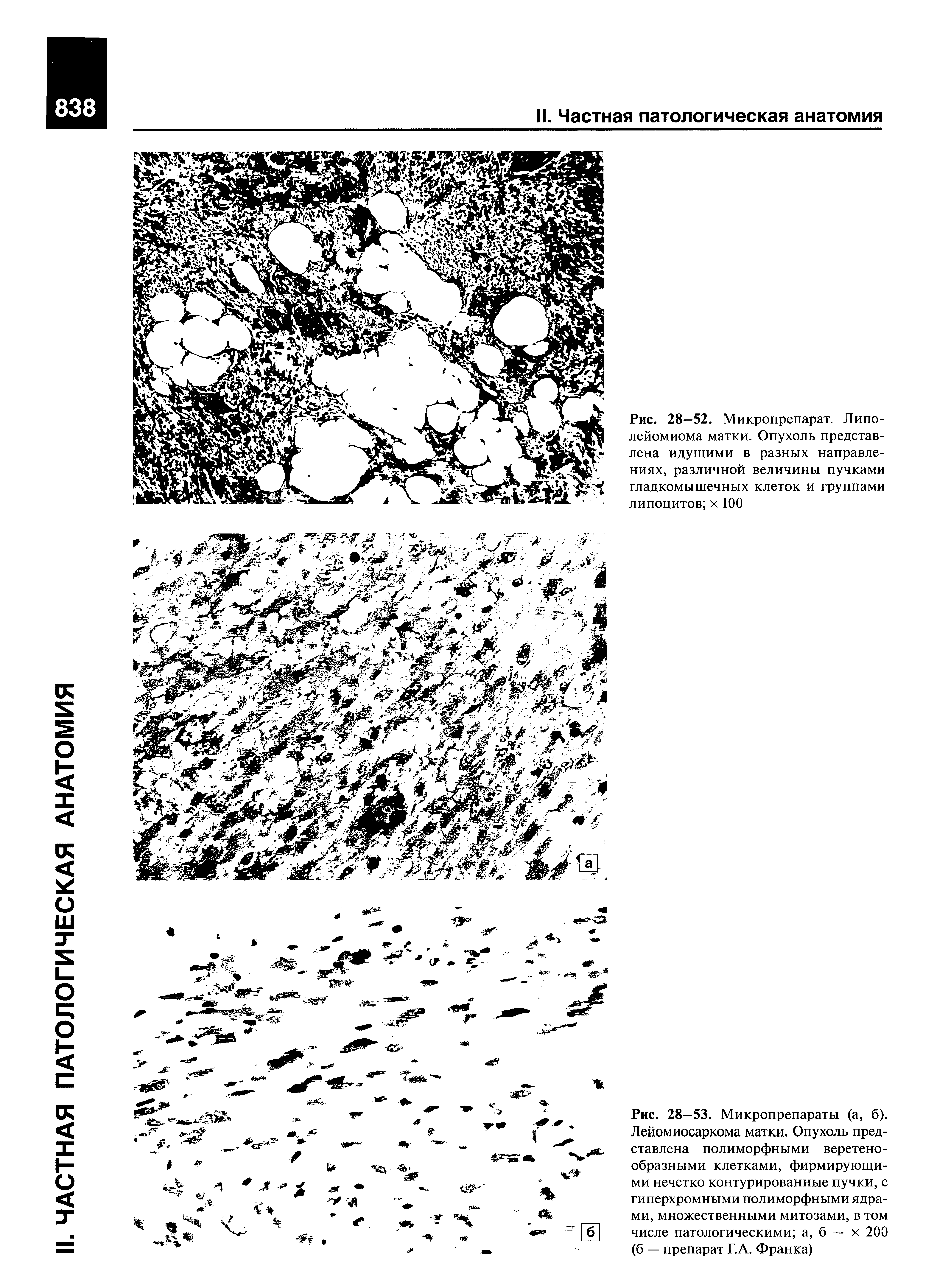 Рис. 28-52. Микропрепарат. Липо-лейомиома матки. Опухоль представлена идущими в разных направлениях, различной величины пучками гладкомышечных клеток и группами липоцитов х 100...