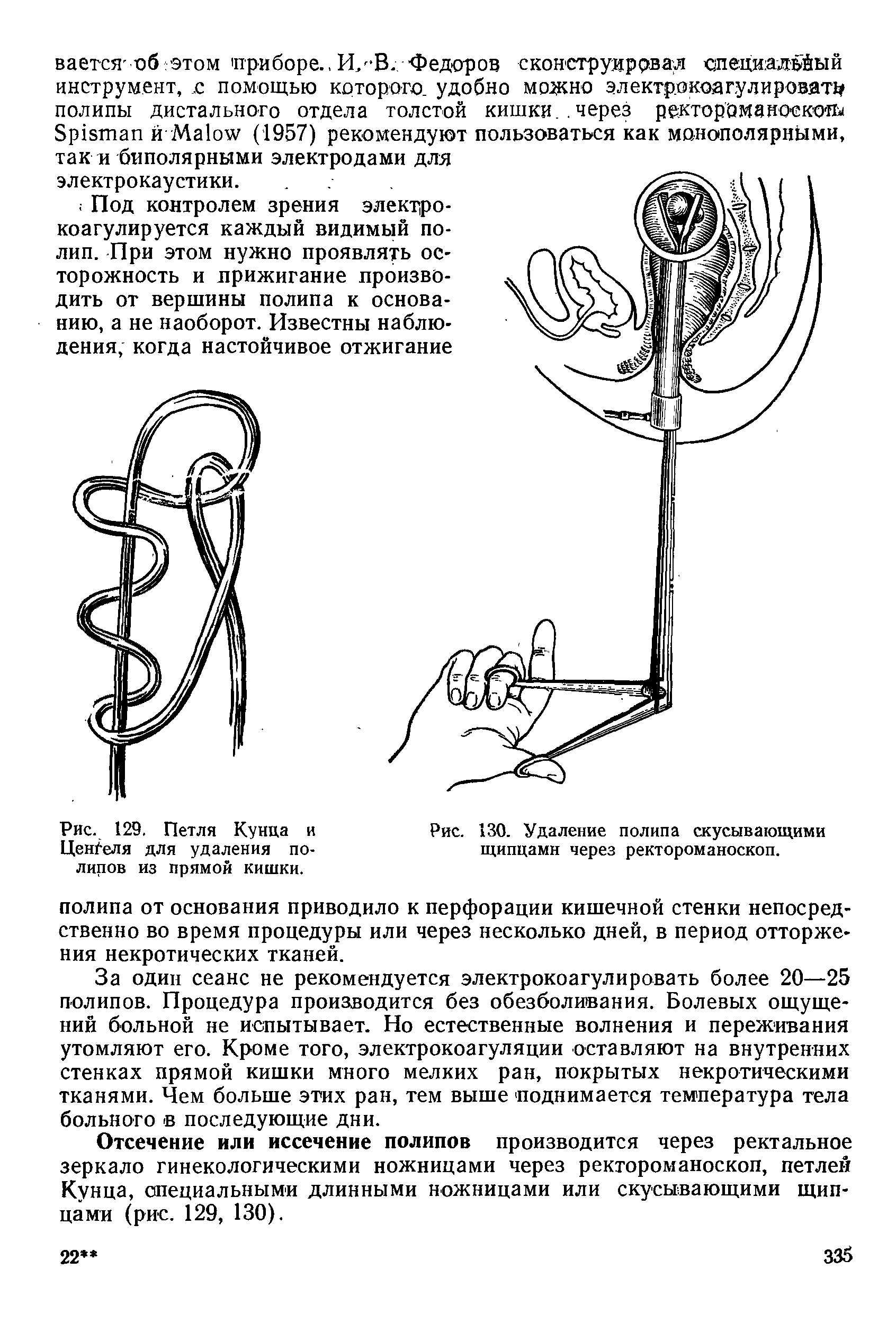 Рис. 129. Петля Кунца и ЦенГеля для удаления полипов из прямой кишки.